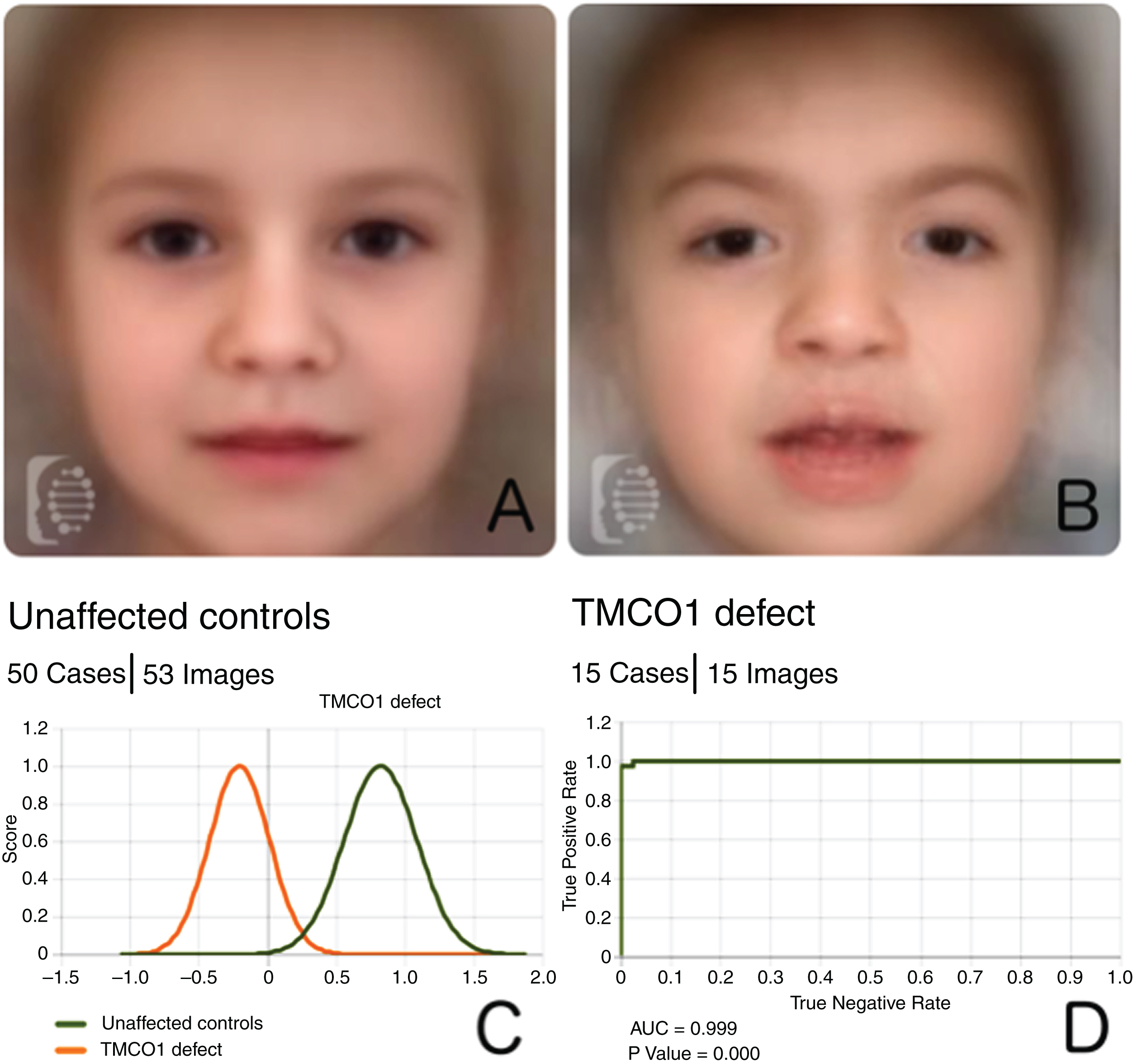 A: Composite photo created by averaging the extracted mathematical information of the photos in the control cohort. B: Composite photo obtained from images of patients with TMCO1 mutations. C: Score distribution of the binary comparison between unaffected controls and patients with TMCO1 mutations. D: ROC curve with pertinent statistics obtained after conducting 10 random splits.