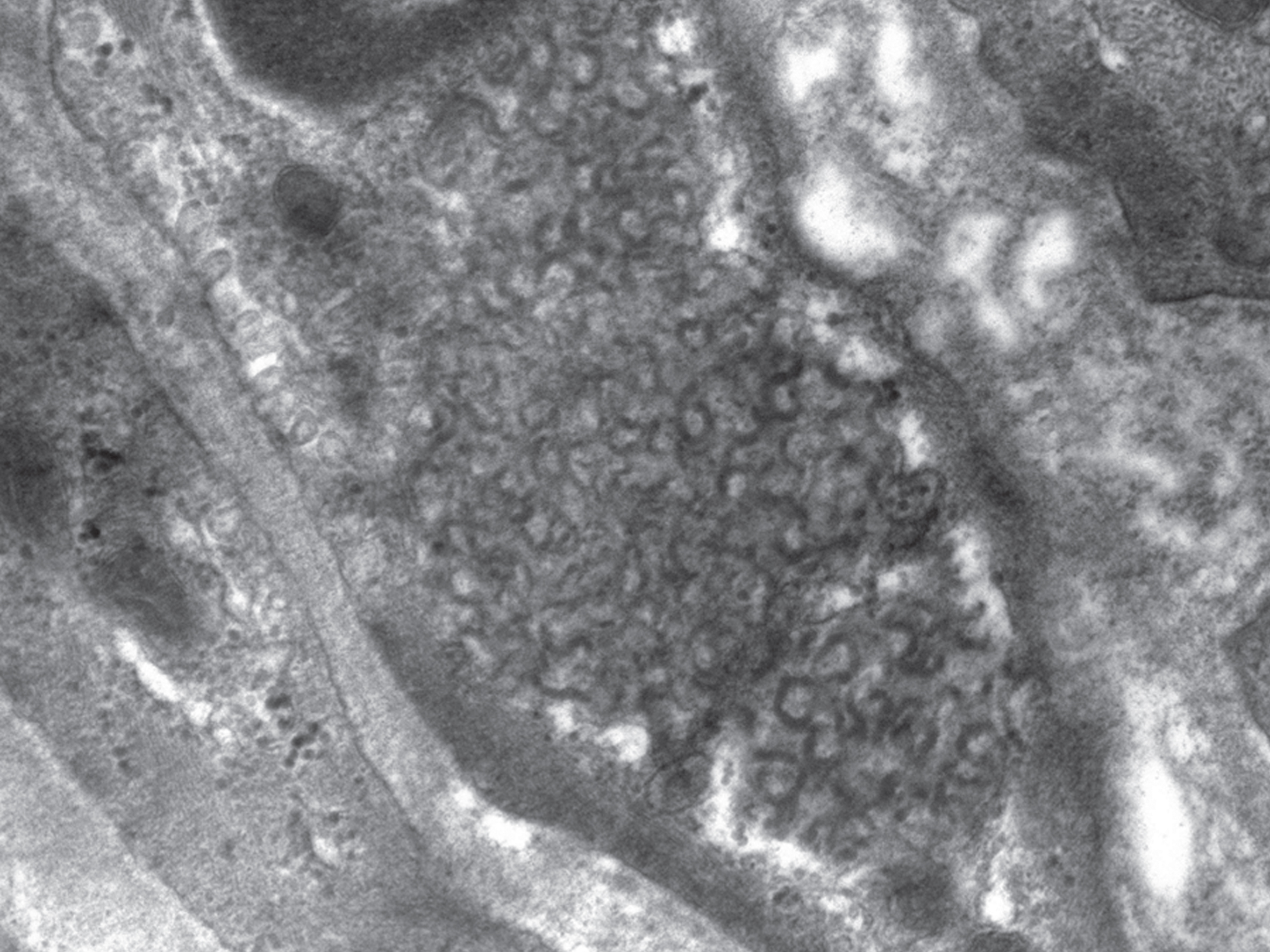 Curvilinear profiles (CLPs) in an endothelial cell. 20,000x magnification.
