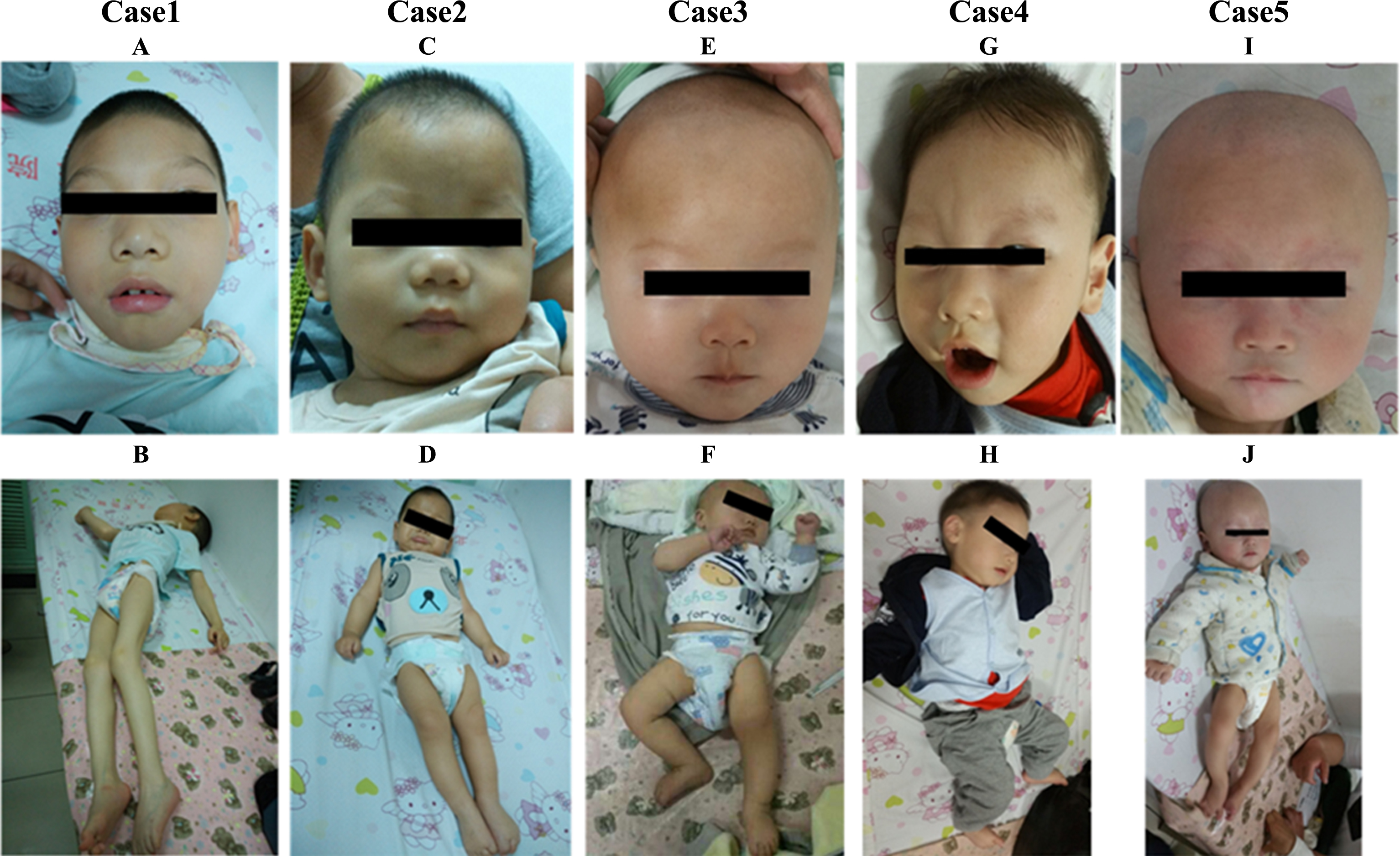 Pictures of 5 AHDS males in our study. A and G show that patients (Case 1 and 4) had facial appearance, including elongated and myopathic face, prominent eyes, narrow forehead, narrow cheeks, bigger ears, tented upper lip. C, E and I show that the patients (Case 2, 3 and 5) had normal appearance. B and J showed patients (Case 1 and 4) displaying twisted posture. Muscle hypoplasia was also obvious in Case 1.