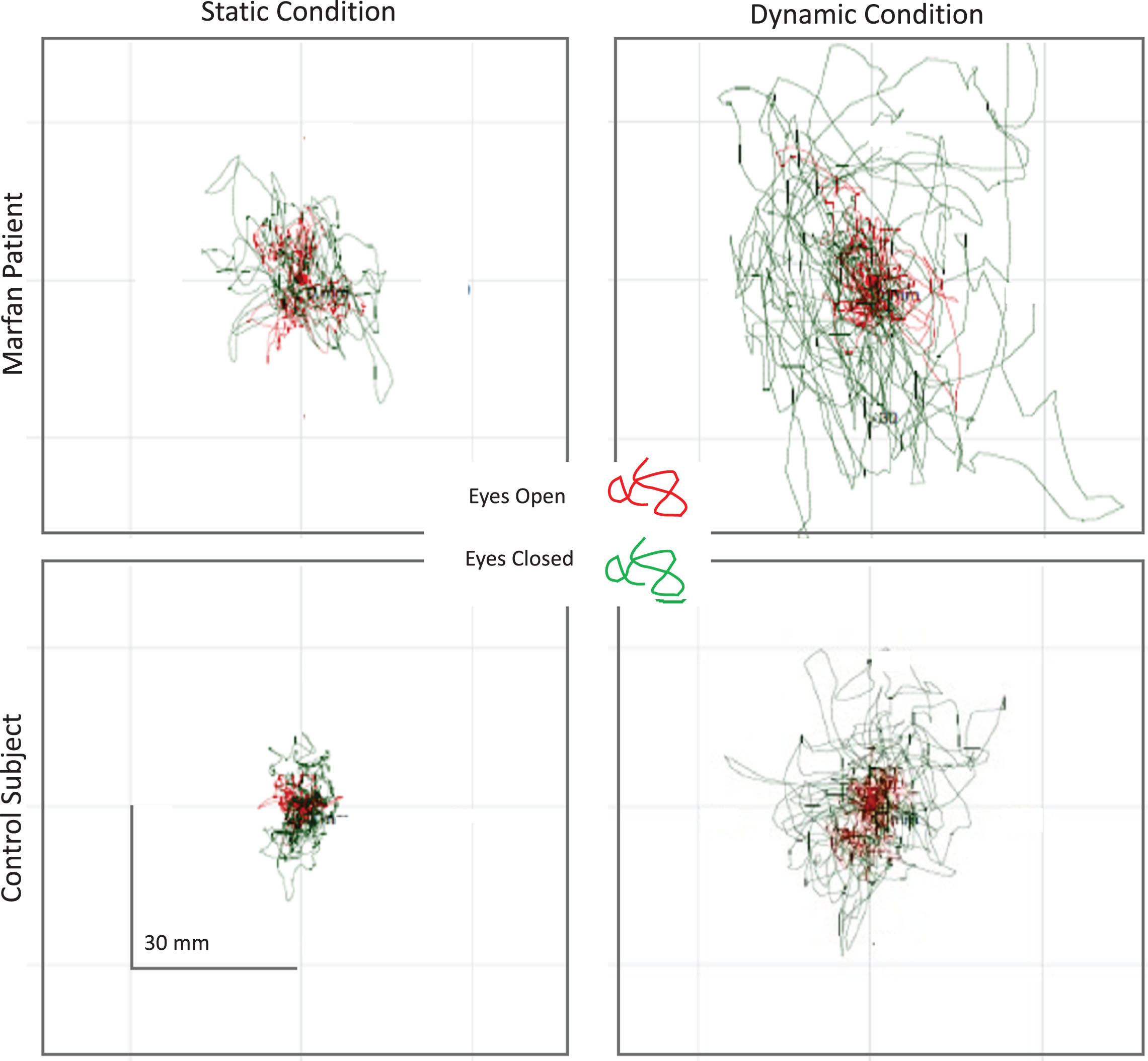 Static (left panels) and dynamic trials (right panels) of a patient with MFS (top) and a healthy subject (bottom). EO trials are shown in red, EC trials in green. The CoP displacement obviously differed between the MFS and the healthy subjects. The differences appear to be much larger under EC than EO condition, and larger under dynamic than static condition.