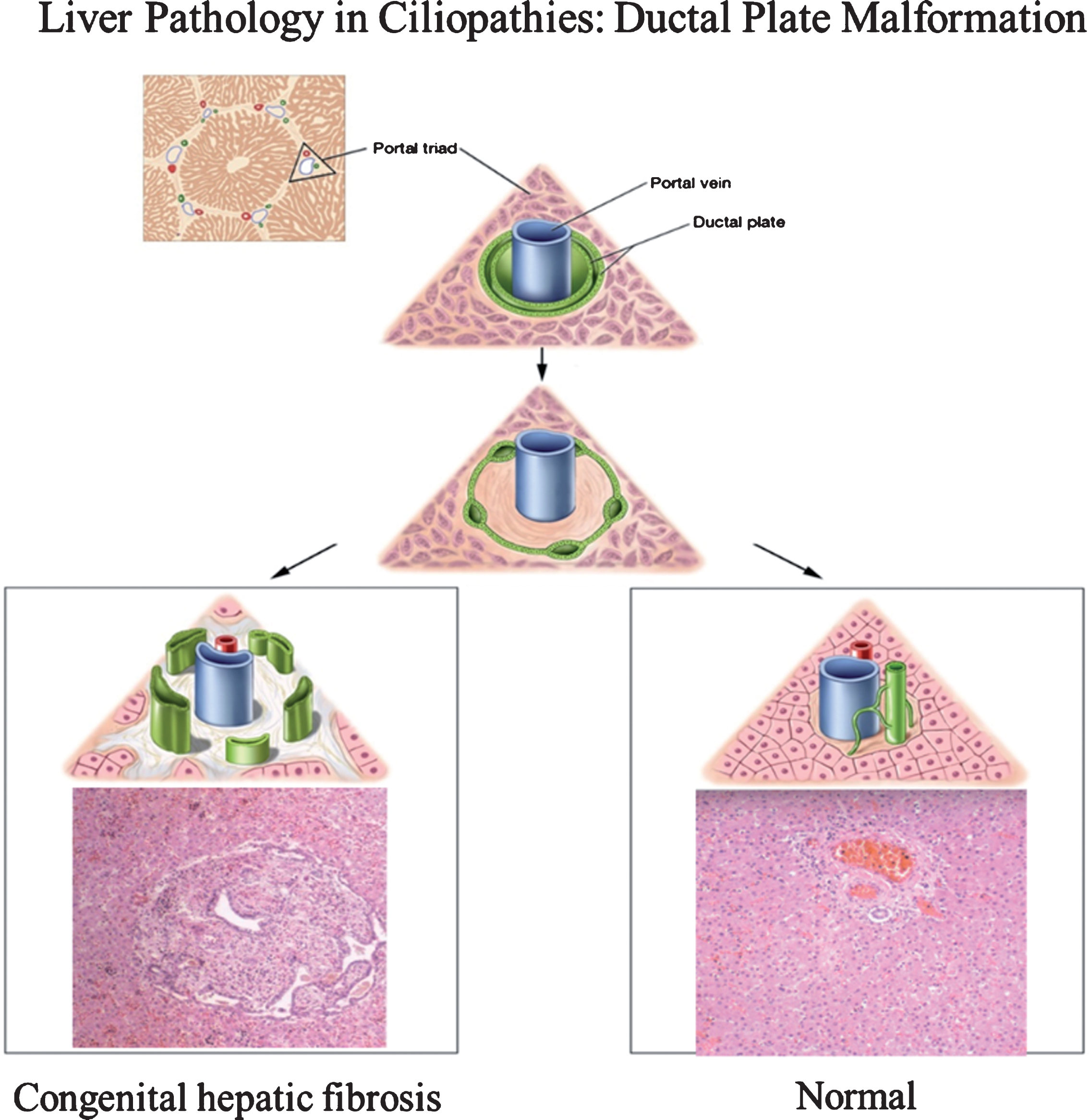 Drawings of ductal plate malformation in comparison to normal bile duct development and corresponding liver histopathology showing congenital hepatic fibrosis (CHF) and normal portal triad. The ductal plate initially forms as a sleeve-like structure around the portal vein branches. Normal remodeling of the ductal plate involves resorption of parts of this structure and migration of the remodeled ducts centrally closer to the portal vein (right panel). The liver biopsy at 10×magnification shows a normal portal tract with sections of portal vein, bile duct, and hepatic artery. Defective remodeling, termed the ductal plate malformation, is characterized by retention of excessive numbers of bile duct remnants in their original peripheral interrupted ring-like position (left panel). The biopsy with CHF shows persistence of bile duct remnants (magnification = 40×). (Liver biopsies are from Potter’s pathology of the fetus, infant and child, 2nd edition, Ed: Gilbert-Barness E. Mosby Elsevier.)