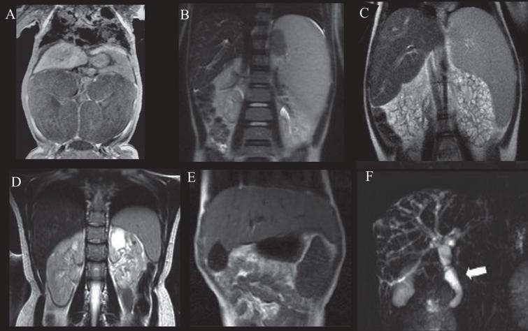 Abdominal MRI of patients with ARPKD displaying variable severities of liver and kidney disease. A) Newborn with ARPKD with massively enlarged kidneys. B) Seven-year-old boy with markedly enlarged spleen and mild kidney disease with imaging findings limited to parts of the medulla, and normal kidney function. C) Six-year-old girl with markedly enlarged spleen and enlarged cystic end stage kidneys with glomerular filtration rate at 22 mL/min/1.73 m2. D) 24-year-old female with mildly enlarged spleen in association with moderate renal disease affecting the entire medulla but only parts of the cortex and decreased glomerular filtration rate at 55 mL/min/1.73 m2. E) Enlarged left lobe of the liver in congenital hepatic fibrosis extending to the left sub-diaphragmatic area. F) ARPKD patient with Caroli’s syndrome. Fusiform and small cystic dilatations of peripheral and central intrahepatic bile ducts as well as fusiform dilatation of the extrahepatic common bile duct (arrow) and large gallbladder.