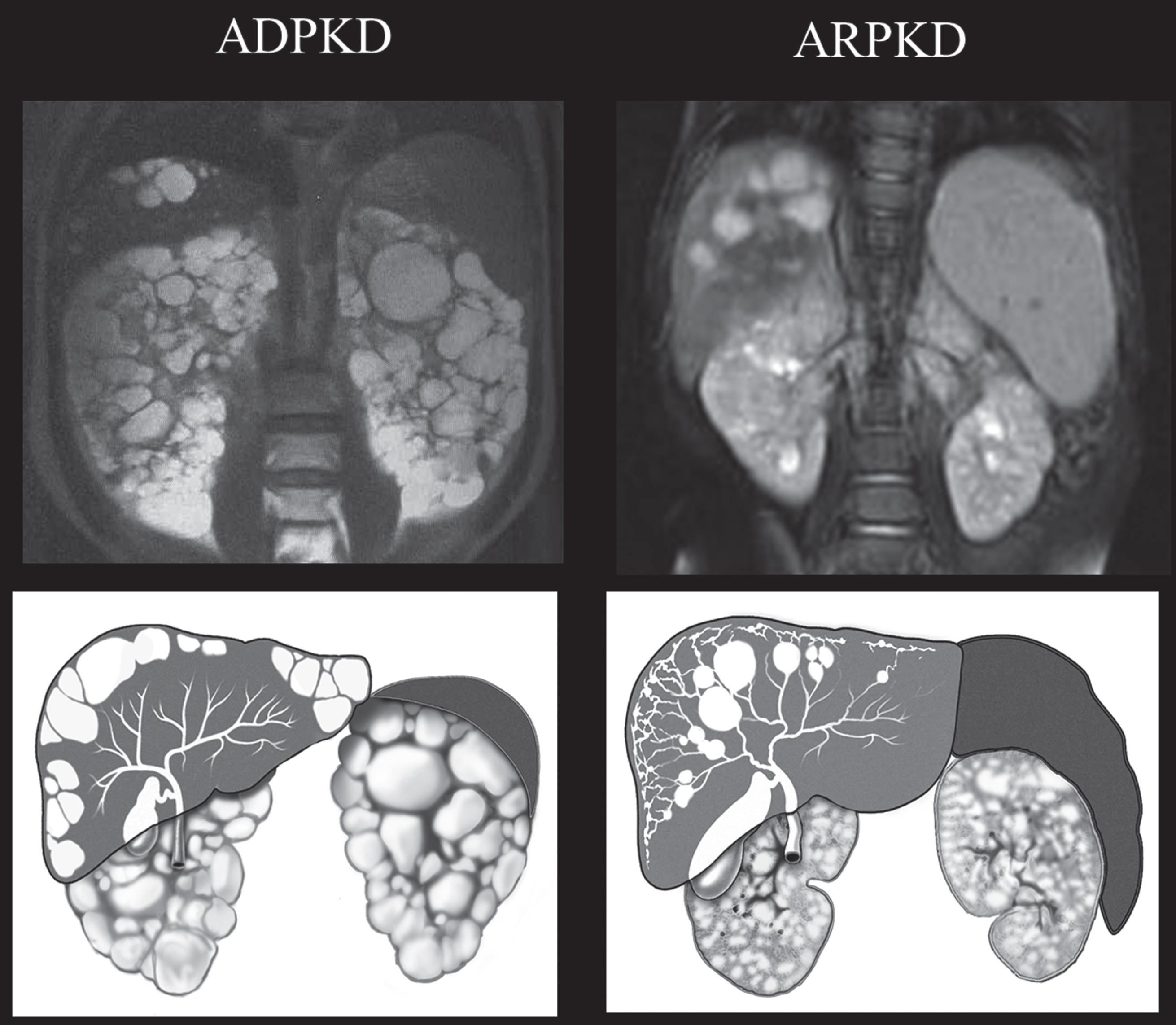 Drawings and MRI images of kidneys, liver, and spleen in ADPKD and ARPKD. In ADPKD portal hypertension is not typical. Therefore, the spleen is not enlarged. Liver cysts in ADPKD are isolated cysts that are not contiguous with the biliary tree. ADPKD kidneys often have distorted contours due to macrocysts. In contrast, in ARPKD, kidneys preserve their reniform contour. CHF in ARPKD is often complicated by portal hypertension evidenced by the enlarged spleen on the MRI. Seventy percent of ARPKD patients also have dilatations of the intra- and extra-hepatic biliary system. (ADPKD MRI is from Heptinstall’s pathology of the kidney, Ed: Jennette J., Olson J., Schwartz M., Silva F.)