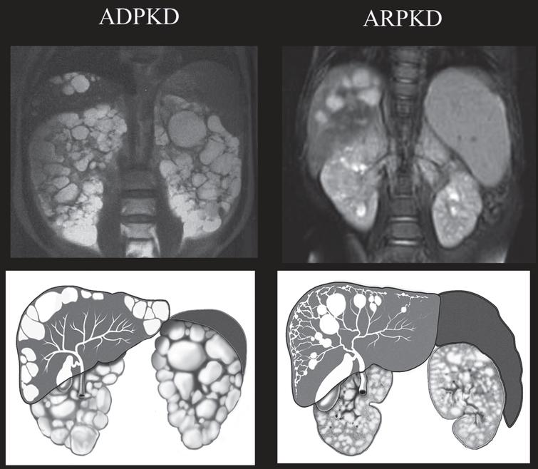 Drawings and MRI images of kidneys, liver, and spleen in ADPKD and ARPKD. In ADPKD portal hypertension is not typical. Therefore, the spleen is not enlarged. Liver cysts in ADPKD are isolated cysts that are not contiguous with the biliary tree. ADPKD kidneys often have distorted contours due to macrocysts. In contrast, in ARPKD, kidneys preserve their reniform contour. CHF in ARPKD is often complicated by portal hypertension evidenced by the enlarged spleen on the MRI. Seventy percent of ARPKD patients also have dilatations of the intra- and extra-hepatic biliary system. (ADPKD MRI is from Heptinstall’s pathology of the kidney, Ed: Jennette J., Olson J., Schwartz M., Silva F.)