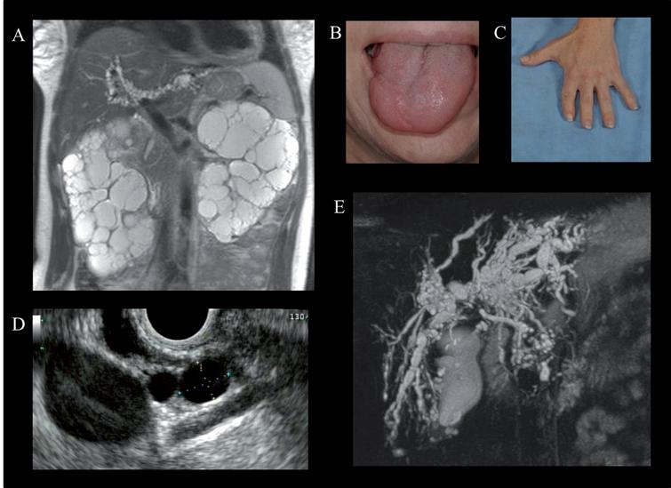 Physical examination and imaging findings in Oral-facial-digital syndrome type 1 (OFD-1). A) Abdominal MRI of a 37-year-old female with OFD-1 showing enlarged polycystic kidneys and beaded dilatations of the intrahepatic bile ducts. Cleft tongue (B) and brachydactyly and repaired syndactyly (C). Endoscopic ultrasound showing multiple pancreatic cysts (D) (courtesy of Dr. Phuong Nguyen, Hoag Memorial Hospital, Newport Beach, CA) and magnetic resonance cholangiopancreatography demonstrating cystic dilatations of the intrahepatic bile ducts (E) in a 38-year-old female with OFD-1.