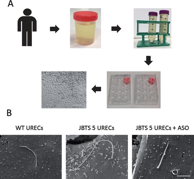 Methodology and application of URECs. (A) Schematic of human urine processing to isolate URECs. Within 4 hours from collection, urine is transferred into 50 ml tubes and is centrifuged. Urine cell pellet is re-suspended in medium and plated on a well of an uncoated tissue culture 12-well plate. Formation of small cell colonies will be observed within 1–2 weeks. When cells reach at least 80% confluence, they can be detached and sub-cultured. Scale bar, 100μm. (B) Scanning electron microscopy (SEM) of wild type and JBTS type 5 patient URECs. SEM reveals that the primary cilium in a JBTS patient carrying the homozygous mutation G1890* in CEP290 is elongated compared to wild type cilium. Treatment with an antisense oligonucleotide (ASO), designed to skip the mutation-carrying exon 41, restores normal cilia length in JBTS 5 URECs. Scale bar, 2μm.