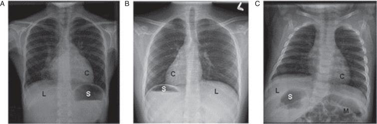 Examples of laterality defects on radiology imaging in various situs groups [133]. Examples of various laterality defects on radiology imaging in PCD. Different situs arrangements found in PCD, including (A) a participant with situs solitus, or normal organ arrangement, with left cardiac apex, left-sided stomach bubble, and right-sided liver; (B) a patient with situs inversus totalis (SIT), or mirror-image organ arrangement, with right cardiac apex, right-sided stomach bubble, and left-sided liver; (C) a patient with situs ambiguus (SA), with left cardiac apex, right-sided stomach bubble, right-sided liver, and intestinal malrotation; This patient also had right-sided polysplenia visualized on a CT scan. C, cardiac apex; S, stomach; L, liver; M, intestinal malrotation. Image and legend reproduced from Shapiro et al, Chest, 2014, with permission from Elsevier [133].