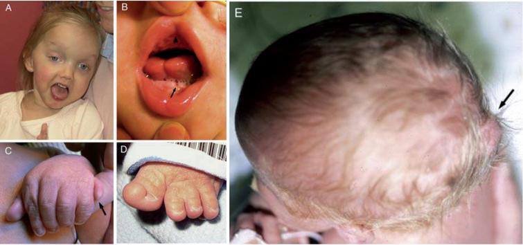 Clinical features in Joubert syndrome. A. Facial features in a girl with JS/COACH syndrome at 27 months of age showing broad forehead, arched eyebrows, strabismus, eyelid ptosis (on right eye), and open mouth configuration indicating reduced facial tone. B. Oral findings in a child with oral– facial– digital syndrome-like features of JS showing midline upper lip cleft (arrowhead), midline groove of tongue, and bumps of the lower alveolar ridge (arrow). C. Left hand of an infant with JS and postaxial polydactyly (arrow). D. Left foot of an infant with JS and preaxial polysyndactyly and fusion of the hallux. E. View from above of an infant with a small occipital encephalocele with protrusion of the occiput of the skull (arrow). (Facial photograph used with permission of the family.) (Previously published in [73] with permission).