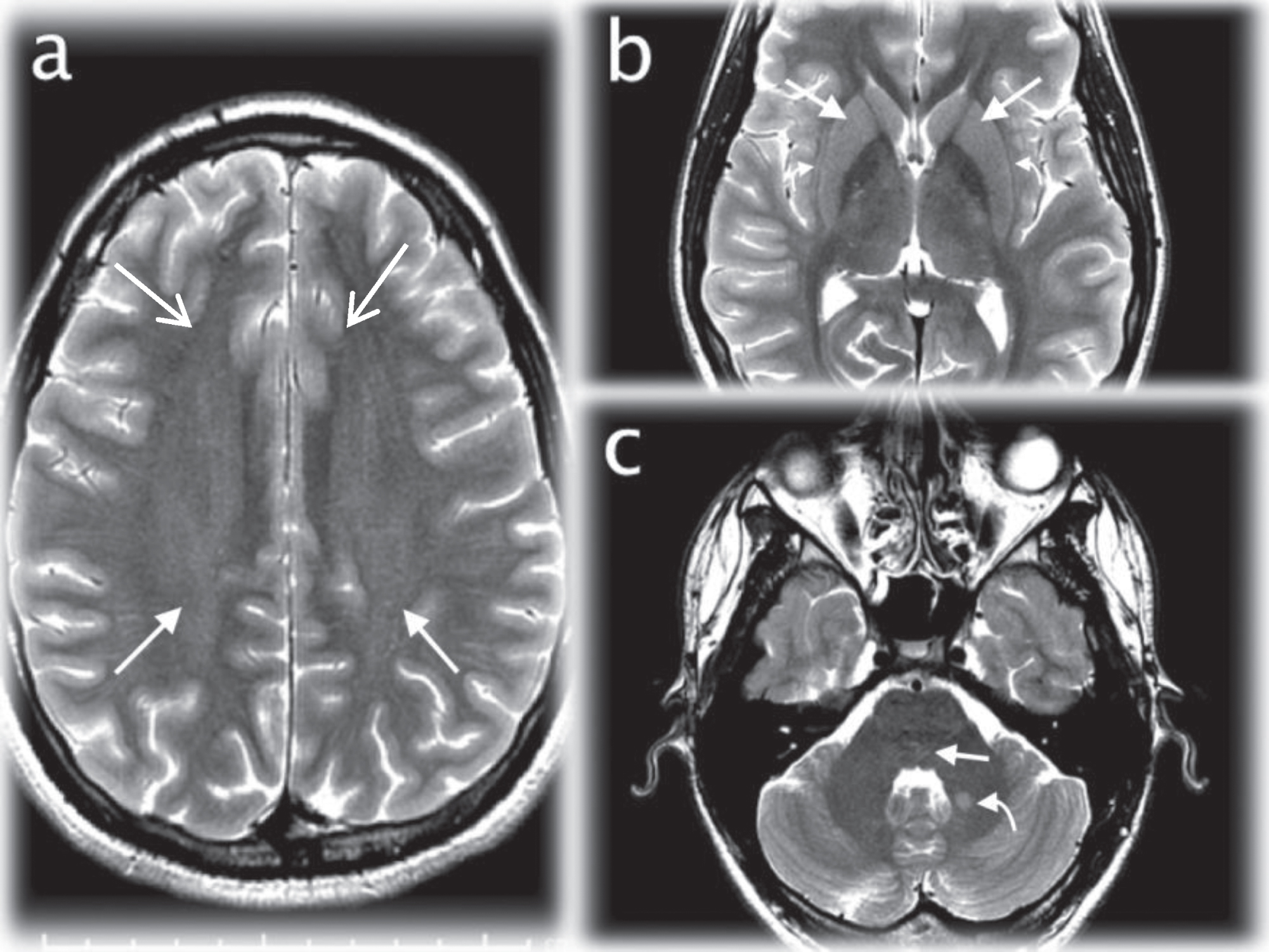Initial brain MRI performed 10 days after admission. Axial T2WI (TR/TE msec, 3200/102) demonstrating increased signal in the frontoparietal white matter (arrows; a), basal ganglia (arrows; b), claustrum (curved arrows; b), pontine tegmentum (arrow; c), and left brachium pontis (curved arrow; c).