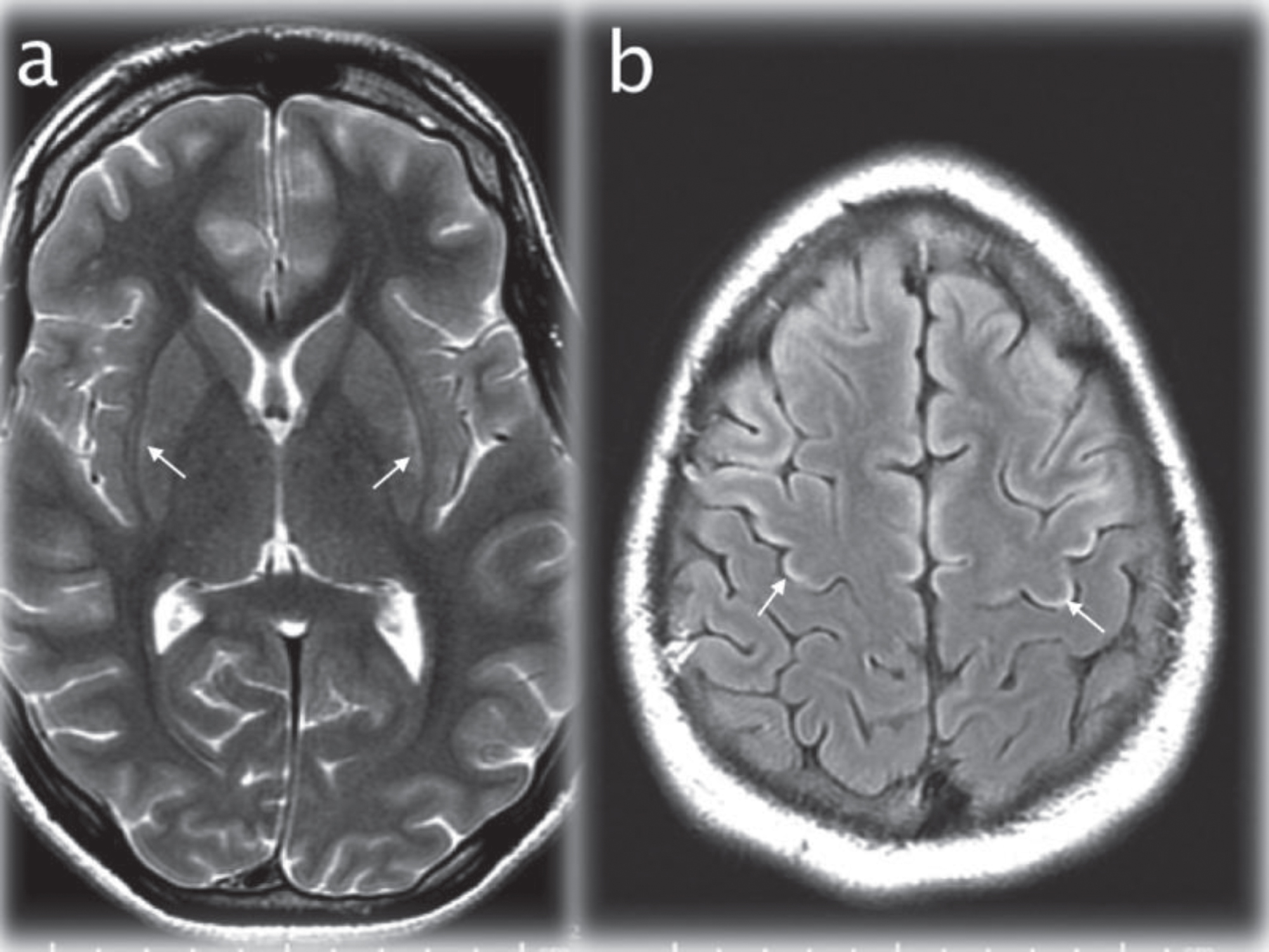 Axial T2WI (TR/TE msec, 4228/98) through the basal ganglia (a) showing maximal signal changes in the lateral putamen at 17 days after admission (arrows). Axial T2 FLAIR image (IT/TR/TE msec, 2250/10000/144) at the cerebral vertex (b) demonstrating cortical hyperintensity in parts of the frontal lobes (for instance the motor strip, arrows) that developed at 28 days after admission.