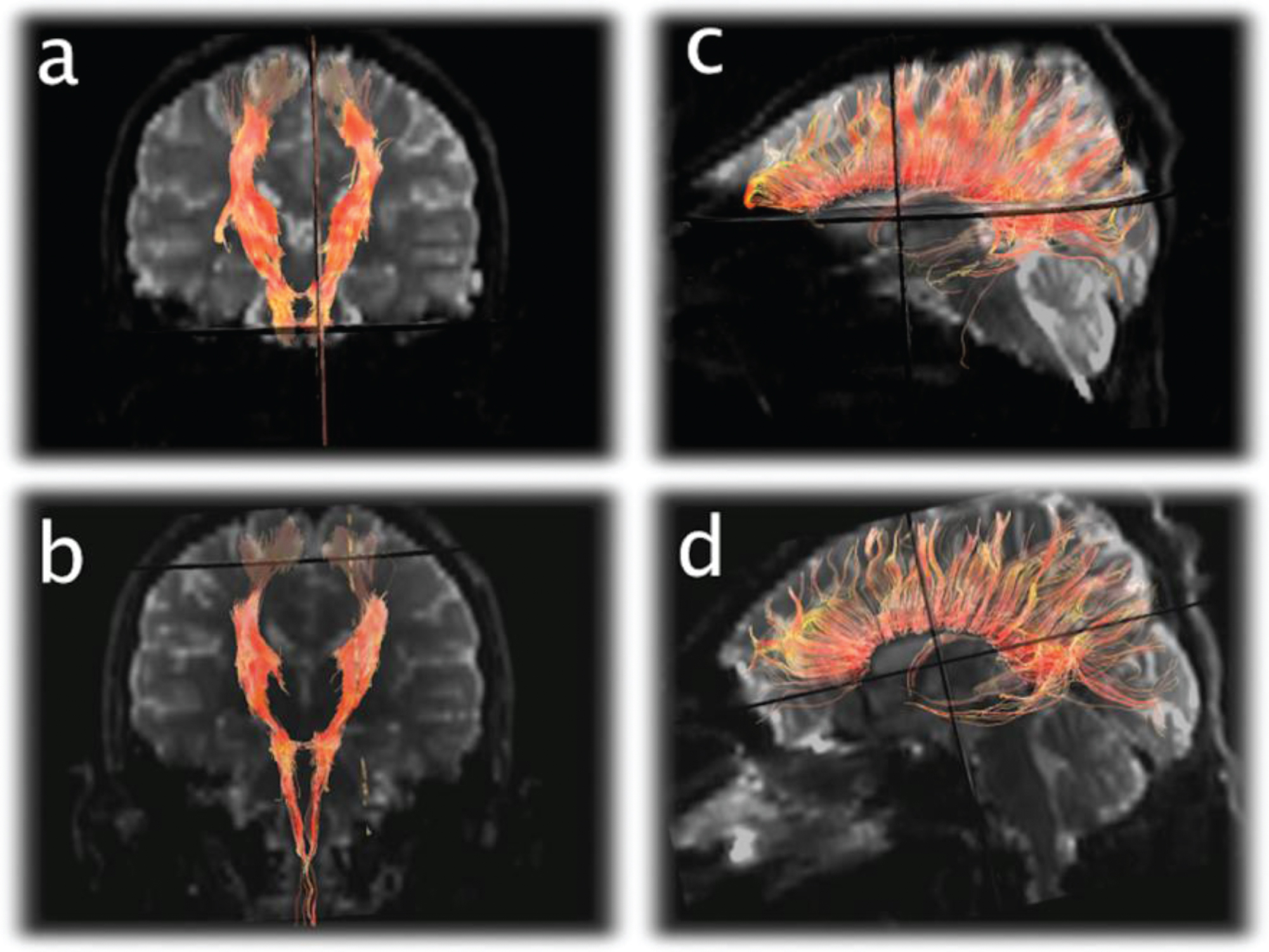 Diffusion Tensor Imaging (DTI) tractography of the corticospinal tracts displayed in the anterioroposterior plane (a and b) and corpus callosum displayed laterally (c and d) from the 1st exam (a and c) and final exam (b and d) demonstrating subtle diminution of the number of projectional and commissural fibers over time.