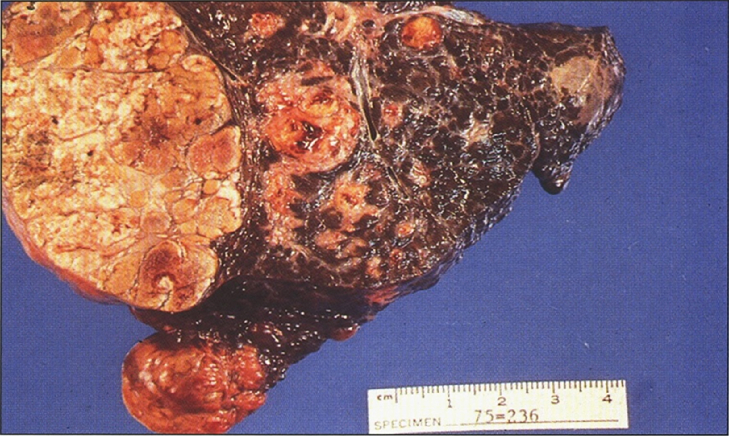 Gross appearance of liver after resection for transplantation showing macronodular and micronodular cirrhosis with large nodule of hepatocellular carcinoma (left) (Figure 7 in the first book).