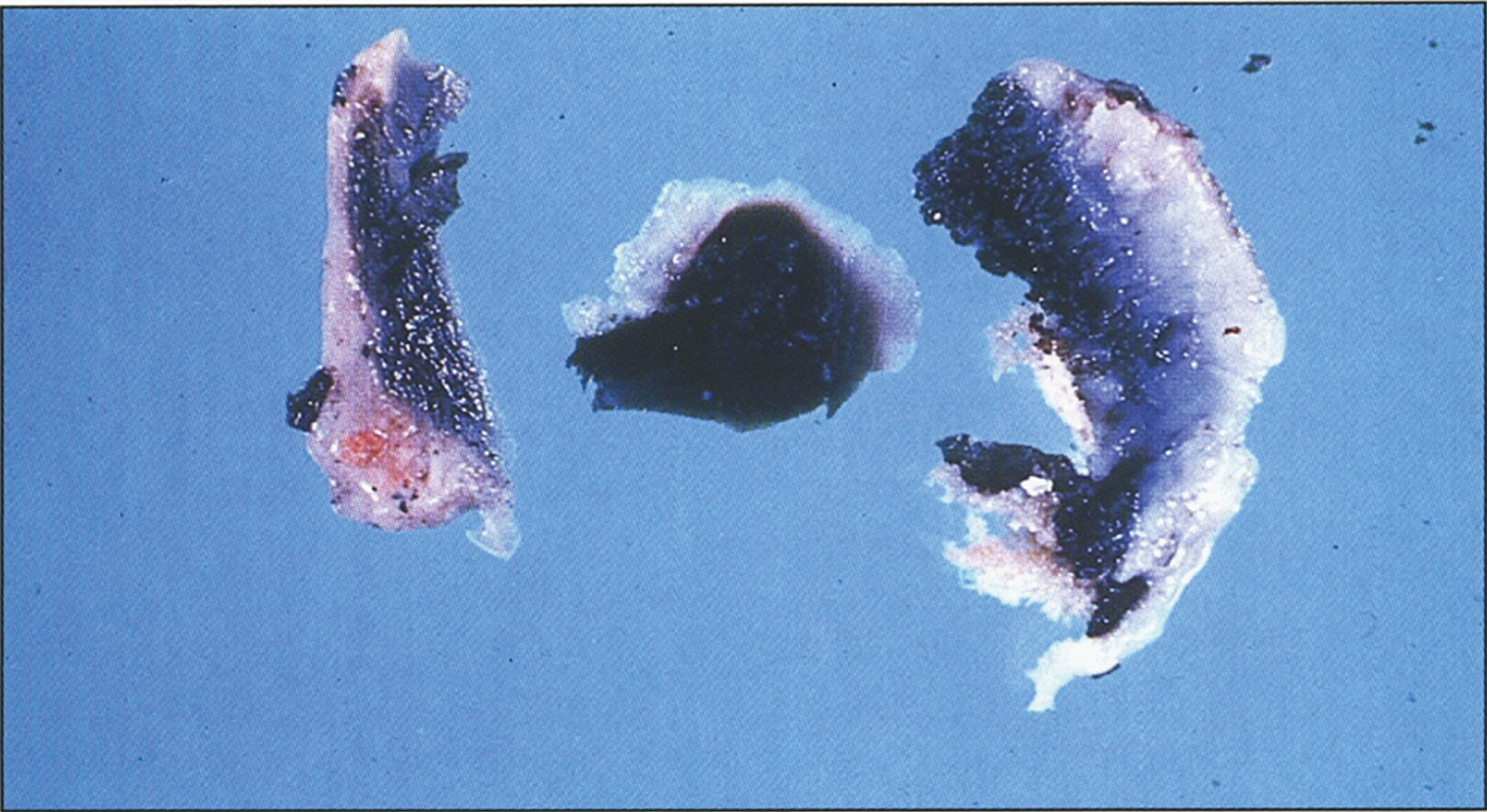 Alkaptonuria-Black pigmental cartilage. (Figure 14 in the first book).