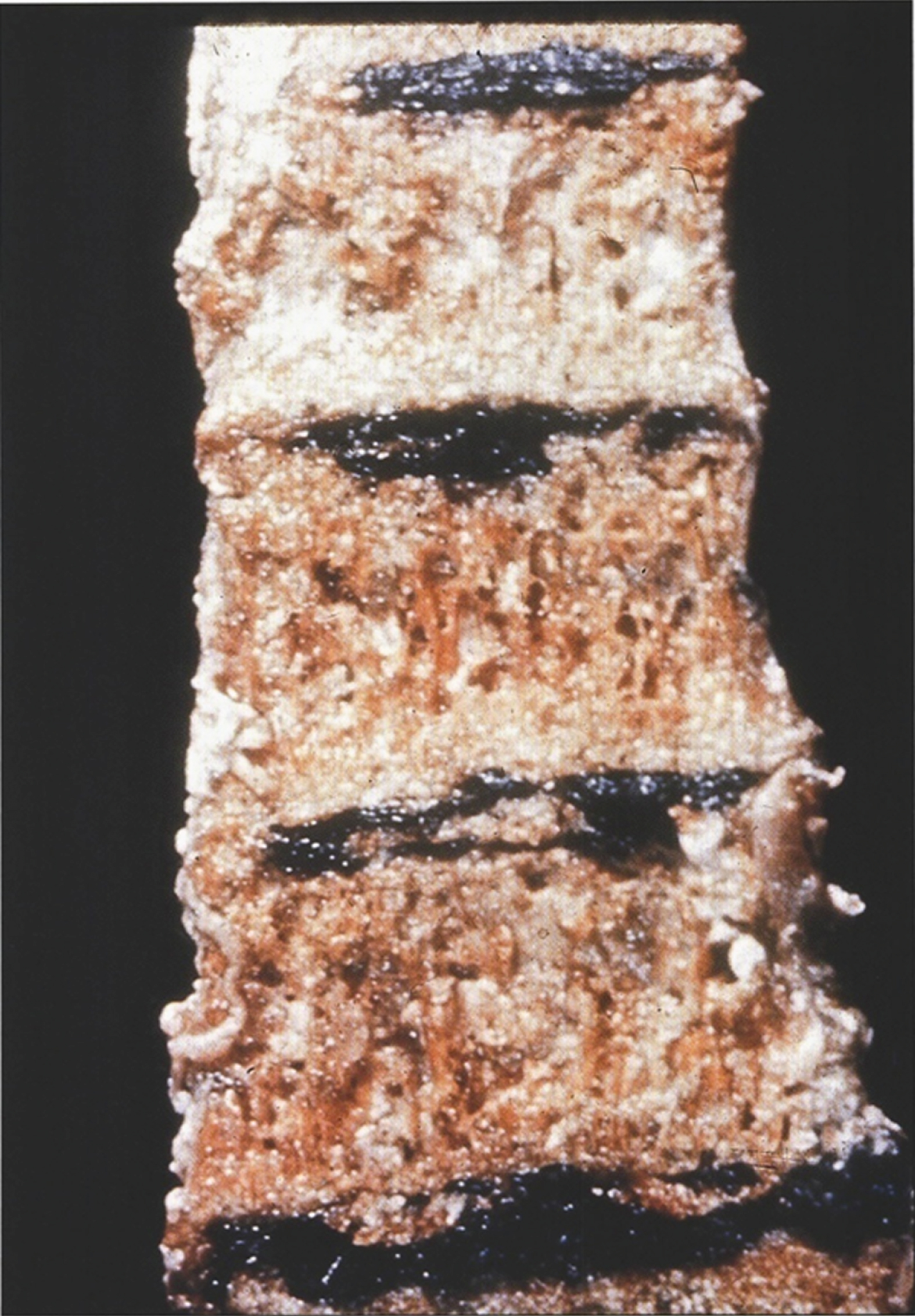 Alkaptonuria-Dense black pigmentation of the intervertebral disks of the vertebrae. (Figure 15 in the first book).