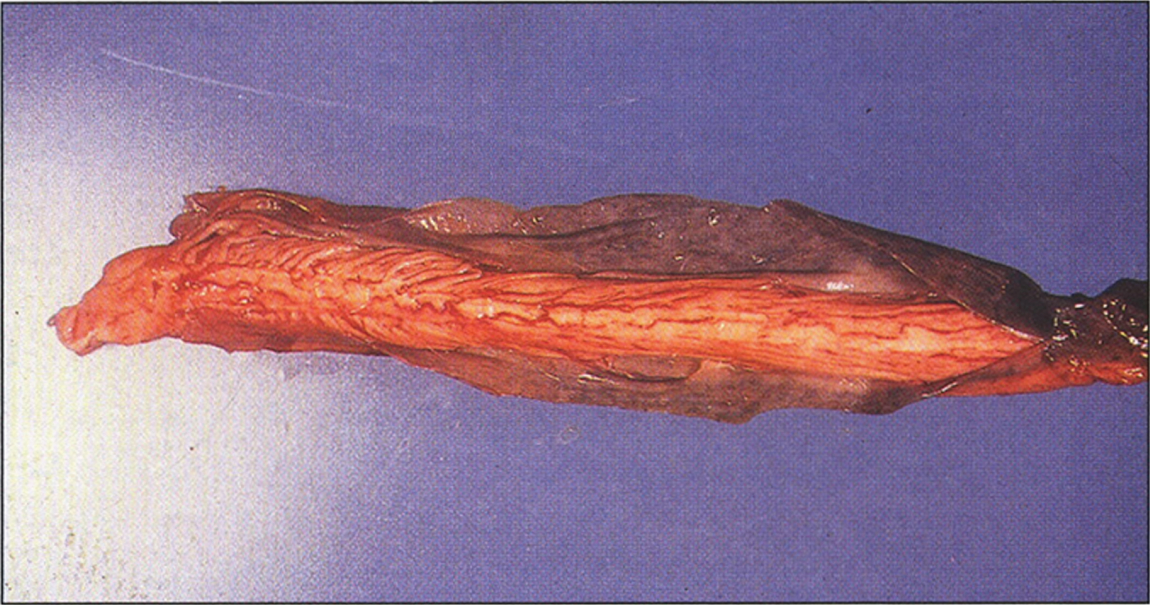 Alkaptonuria- A segment of the spinal cord covered by densely pigmented dura mater. (Figure 18 in the first book).