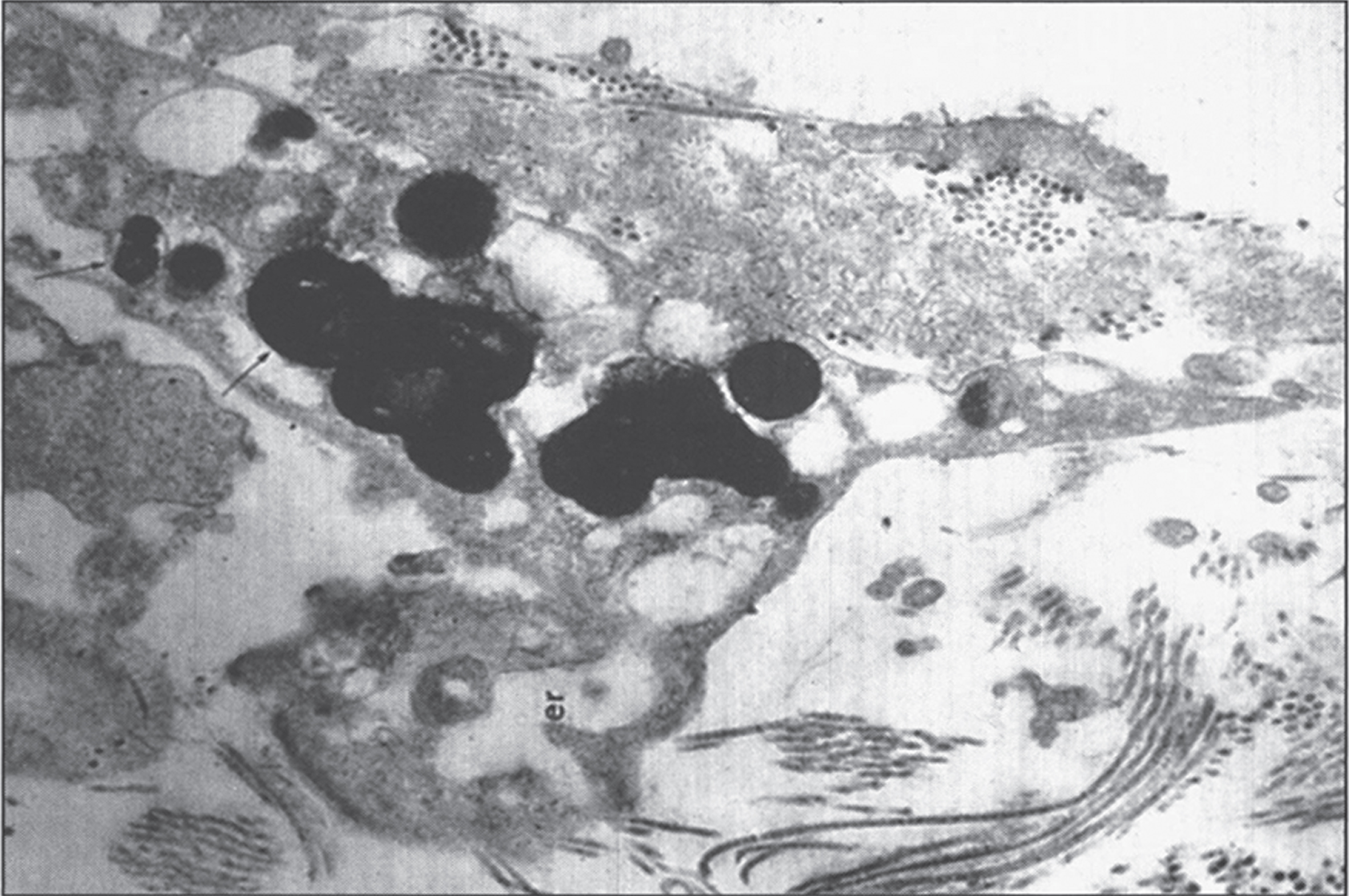Alkaptonuria- Electron micrography of cartilage with dense pigment deposit in the collagen. (Figure 20 in the first book).