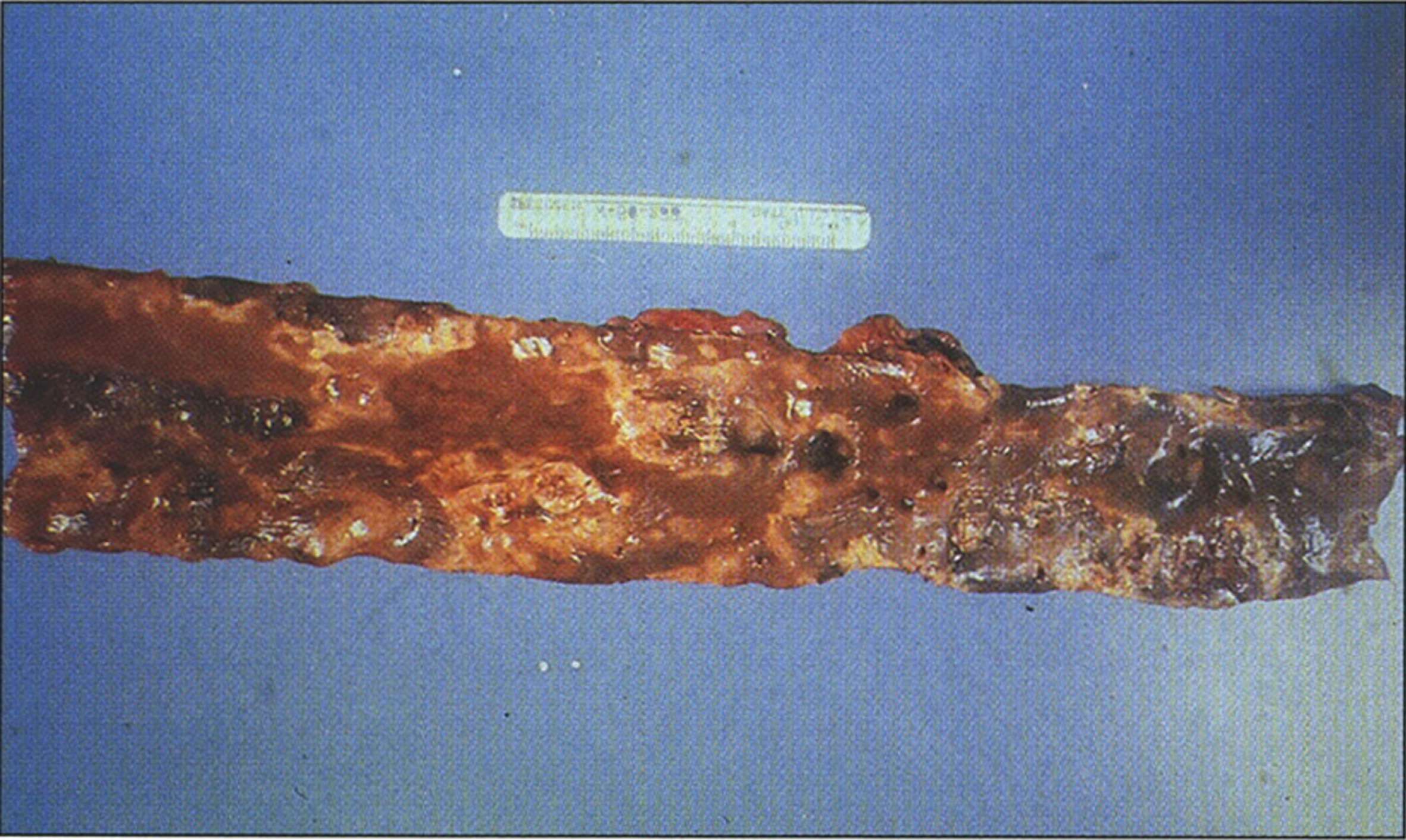 Alkaptonuria- A segment of the aorta showing pigmented atherosclerotic plaques. The presence of the pigment augments and accelerates the atherosclerotic process. (Figure 21 in the first book).