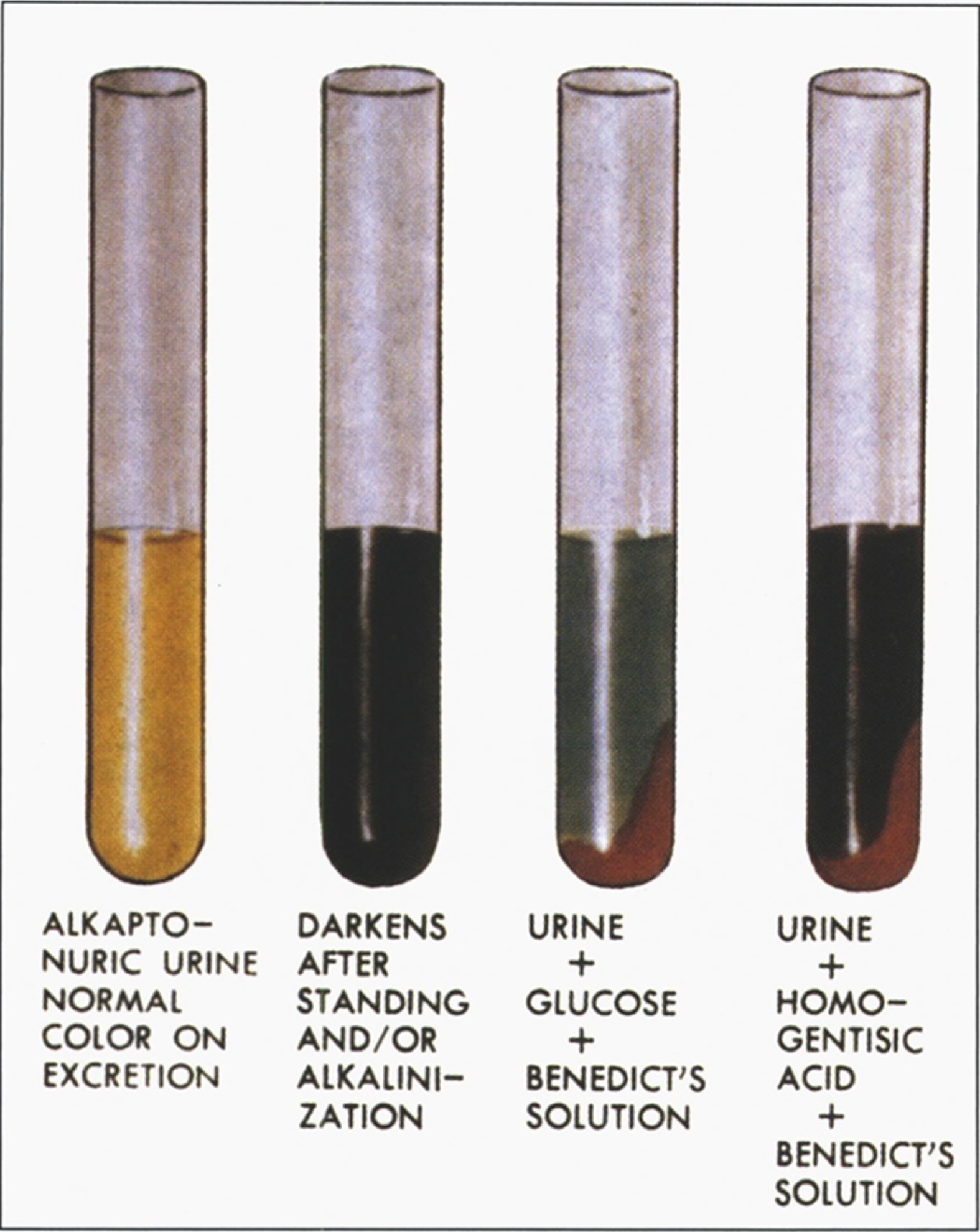 Alkaptonuria- The reaction of urine to oxidation, alkali, and Benedict’s solution. (Figure 13 in the first book).