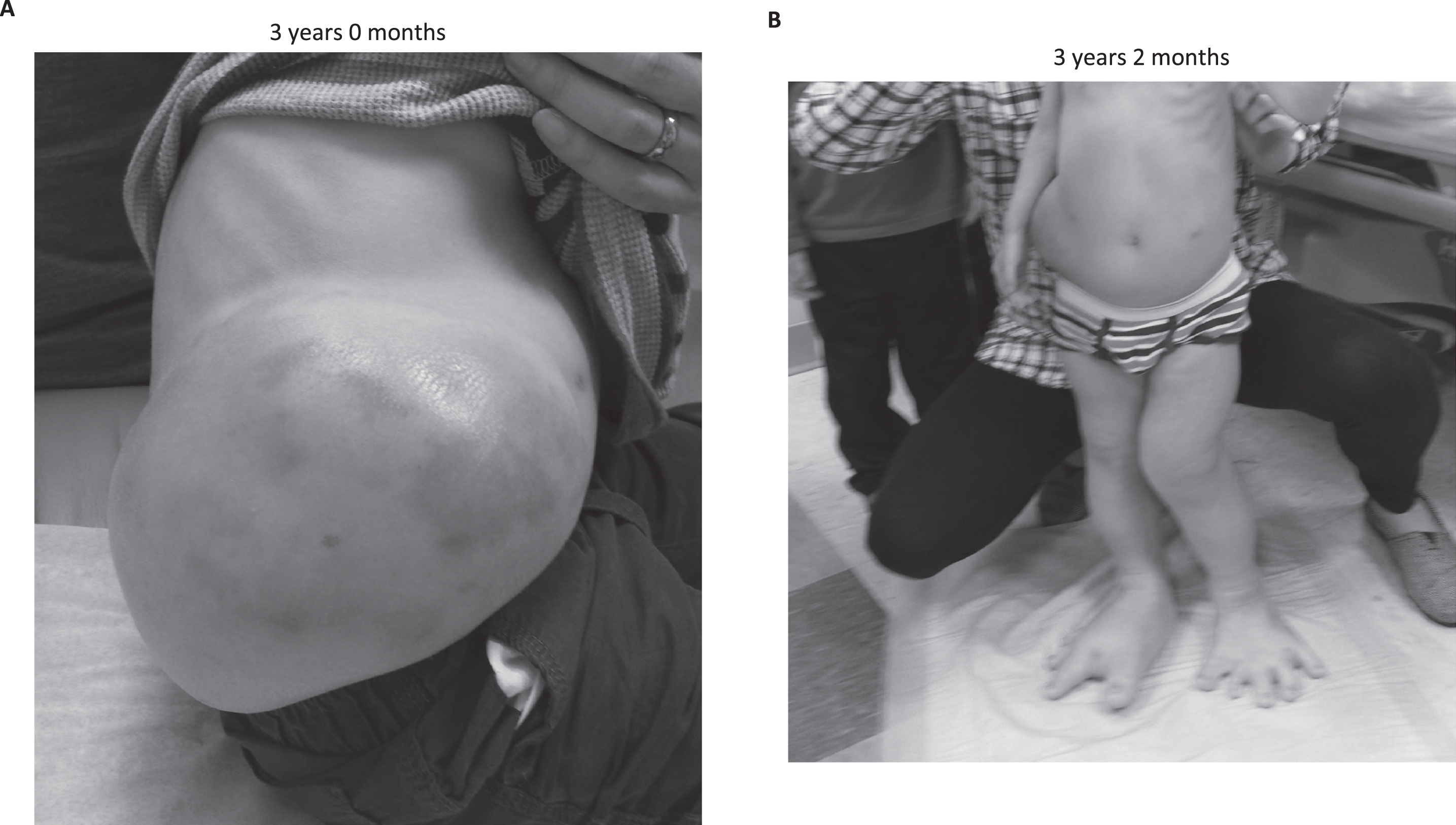 Clinical improvement after initiation of sirolimus therapy. A) Initial examination revealed a taught, painful 26 cm×16 cm right flank mass extending from the costal margin to the sacrum and several port-wine stains. B.) There was a noticeable clinical reduction in the flank mass within 2 months of sirolimus initiation.
