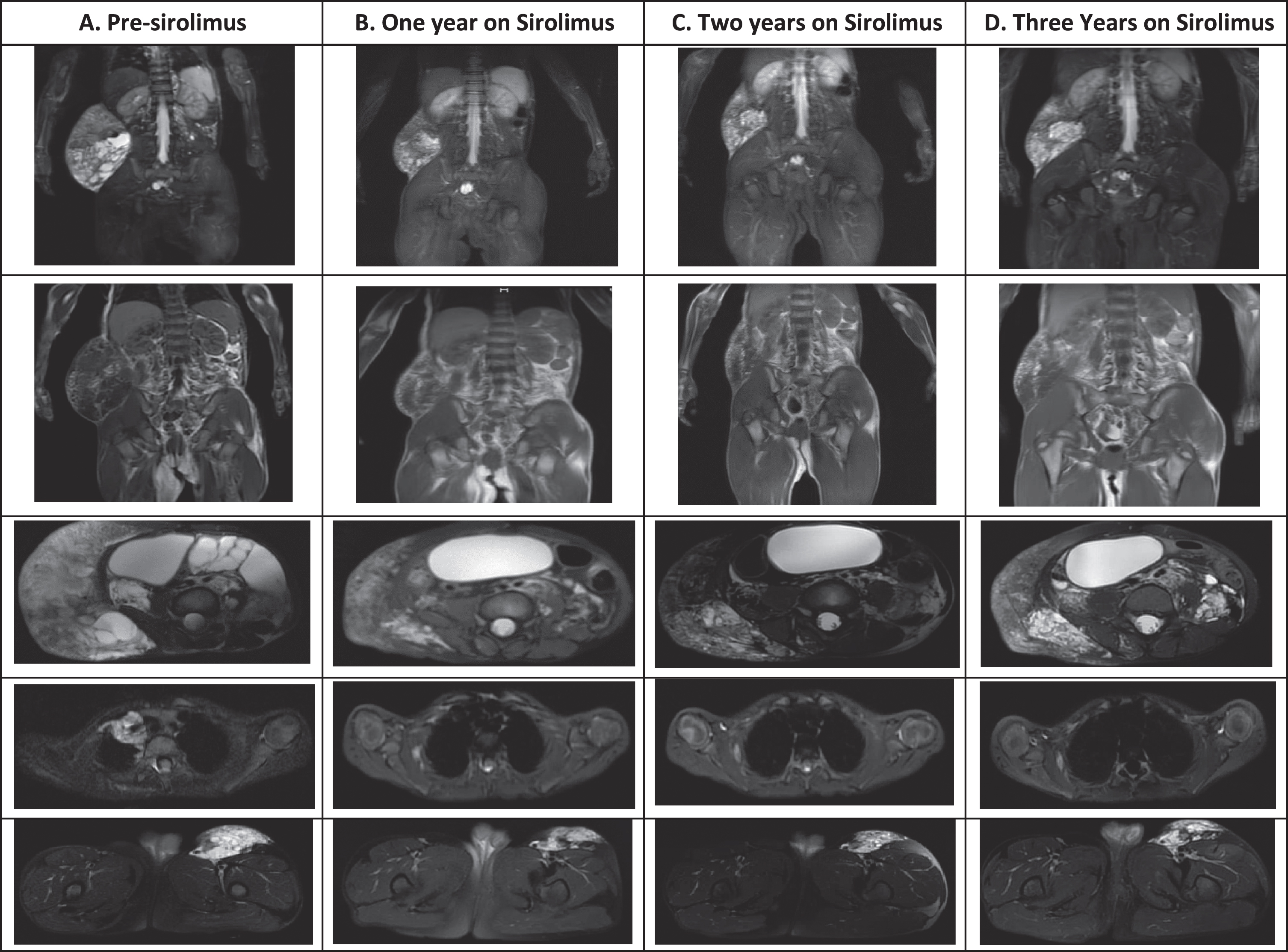 Radiographic changes before and after initiation of sirolimus therapy. Images from top to bottom were done with short TI inversion recovery (STIR), fat spin echo (FSE) T1, and T2 fat saturated imaging for the remaining images. A.) MRI prior to initiation of therapy demonstrated a 3.1×2.6×3.2 cm paratracheal, 5.6×15.4×13.4 cm exophytic right abdominal wall, and 9.4×6.7×3.2 cm anterior left thigh lymphatic malformations. There were multiple extensive and cystic lymphatic malformations throughout the abdomen and pelvis with extension through a defect within the left anterior pelvic wall to the left thigh, bilateral renal pelviectasis, and marked bladder extension and mass effect on the bowel secondary to the large lymphatic malformation. Age 3 years. B). Repeat MRI within one year on sirolimus therapy was no longer able to visualize the paratracheal mass, the exophytic mass decreased to 5×10.4×12.8 cm, the left thigh mass decreased to 5.4×2.1×2.4 cm, there was marked overall decrease in the cystic components, and the kidneys were normal in size and contour. Age 4 years. C-D. MRI two and three years on sirolimus therapy was stable. Age 5-6 years.