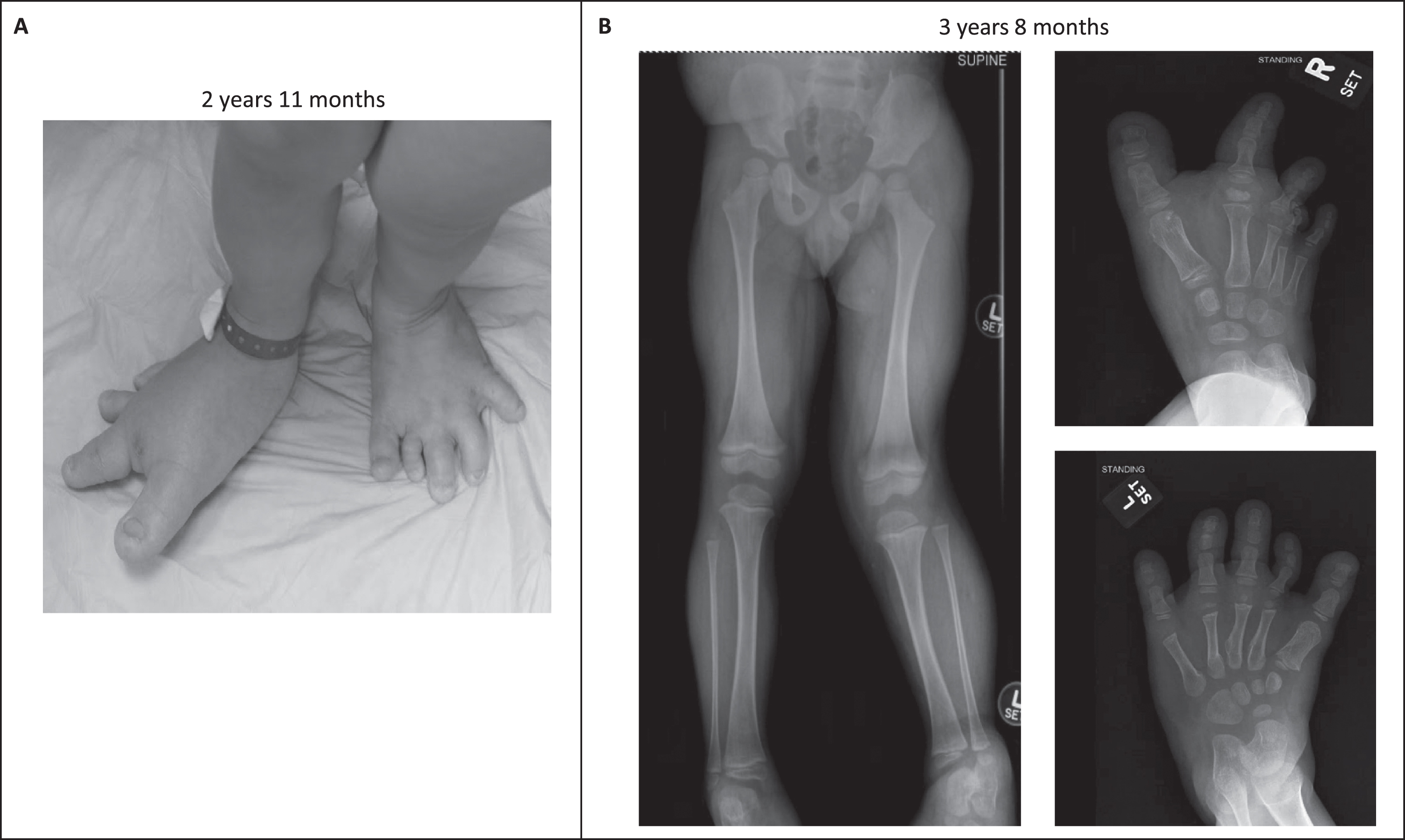 Initial clinical and radiographic orthopaedic evaluation. A-B). He presented with severe mosaic overgrowth of both feet, left genu valgum, and a mild leg length discrepancy.