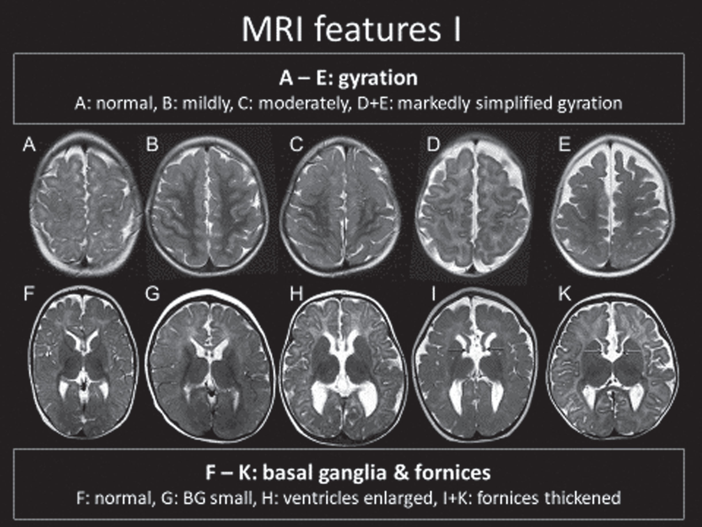 MRI Features of FOXG1 Disorder: Gyral Patterns.