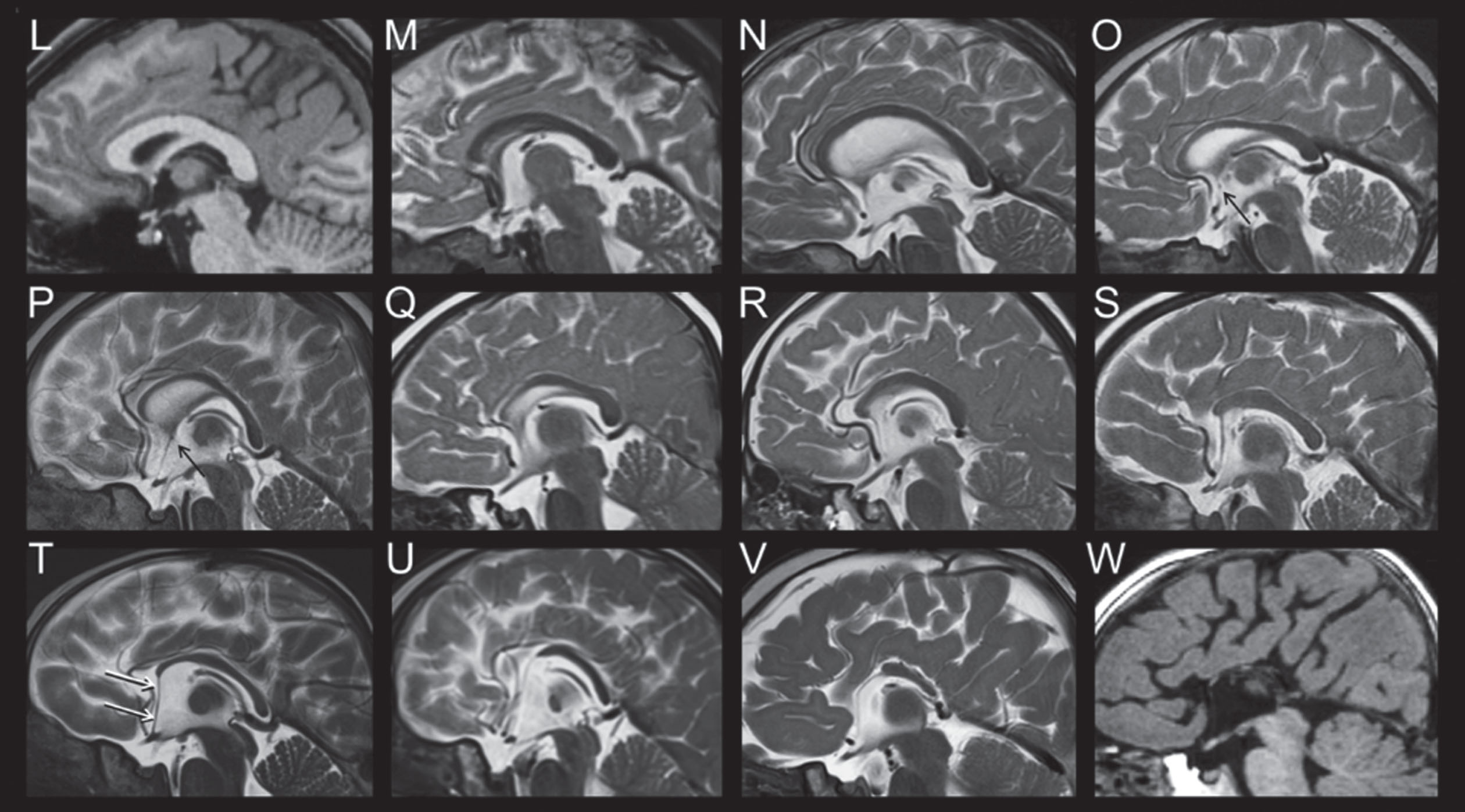 MRI Features of FOXG1 Disorder: Corpus Callosum Alterations.