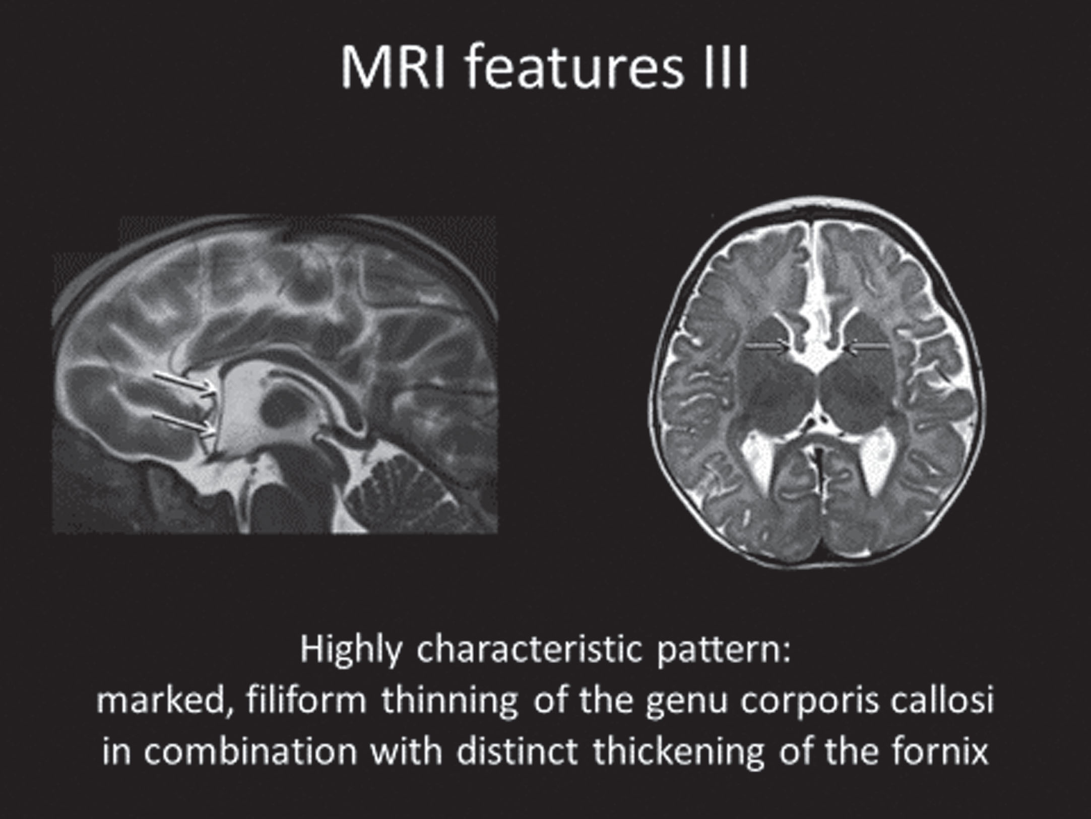 MRI Features of FOXG1 Disorder: Thickening of the Fornix.