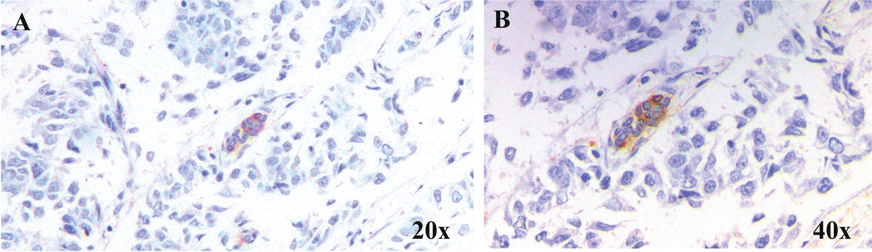 Expression of Gal-3 in tumour emboli. Representative microscopic images of breast carcinoma samples at A. 20×and B. 40×showing the expression of Gal-3 in lymphatic tumour emboli. Gal-3 expression was studied in samples by immunohistochemical method and counter-staining with haematoxylin following standard protocol.
