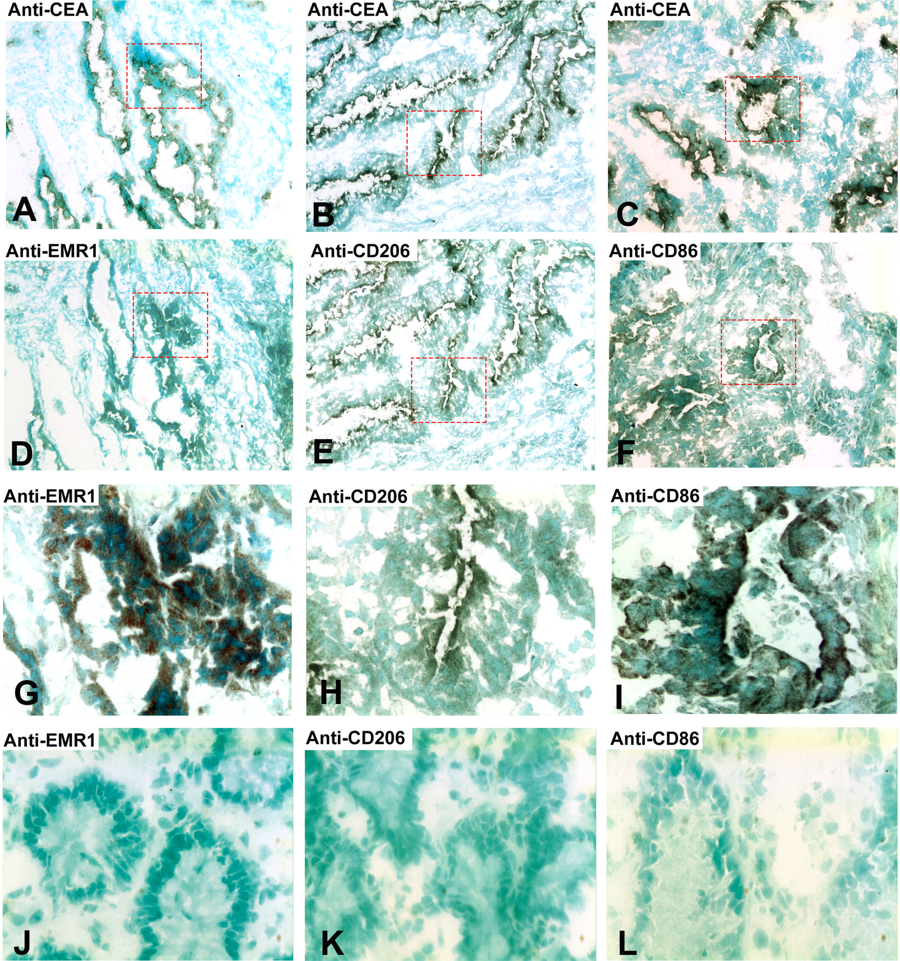 Immunoperoxidase staining of tissue sections of a primary CC tumor. (A), (B), (C) Anti-CEA staining, original magnification 100×. (D) Anti-EMR1 staining of a consecutive section of (A), original magnification 100×. (E) Anti-CD206 staining of a consecutive section of (B), original magnification 100×. (F) Anti-CD86 staining of a consecutive section of (C), original magnification 100×. (G) Higher magnification of indicated area in (D), 400×. (H) Higher magnification of indicated area in (E), 400×. (I) Higher magnification of indicated area in (F), 400×. (J) Anti-EMR1 staining of normal colon tissue, 400x. (K) Anti-CD206 staining of normal colon tissue, 400x. (L) Anti-CD86 staining of normal colon tissue, 400x. Positive cells stained brown to black. Methyl-green was used for counterstaining.