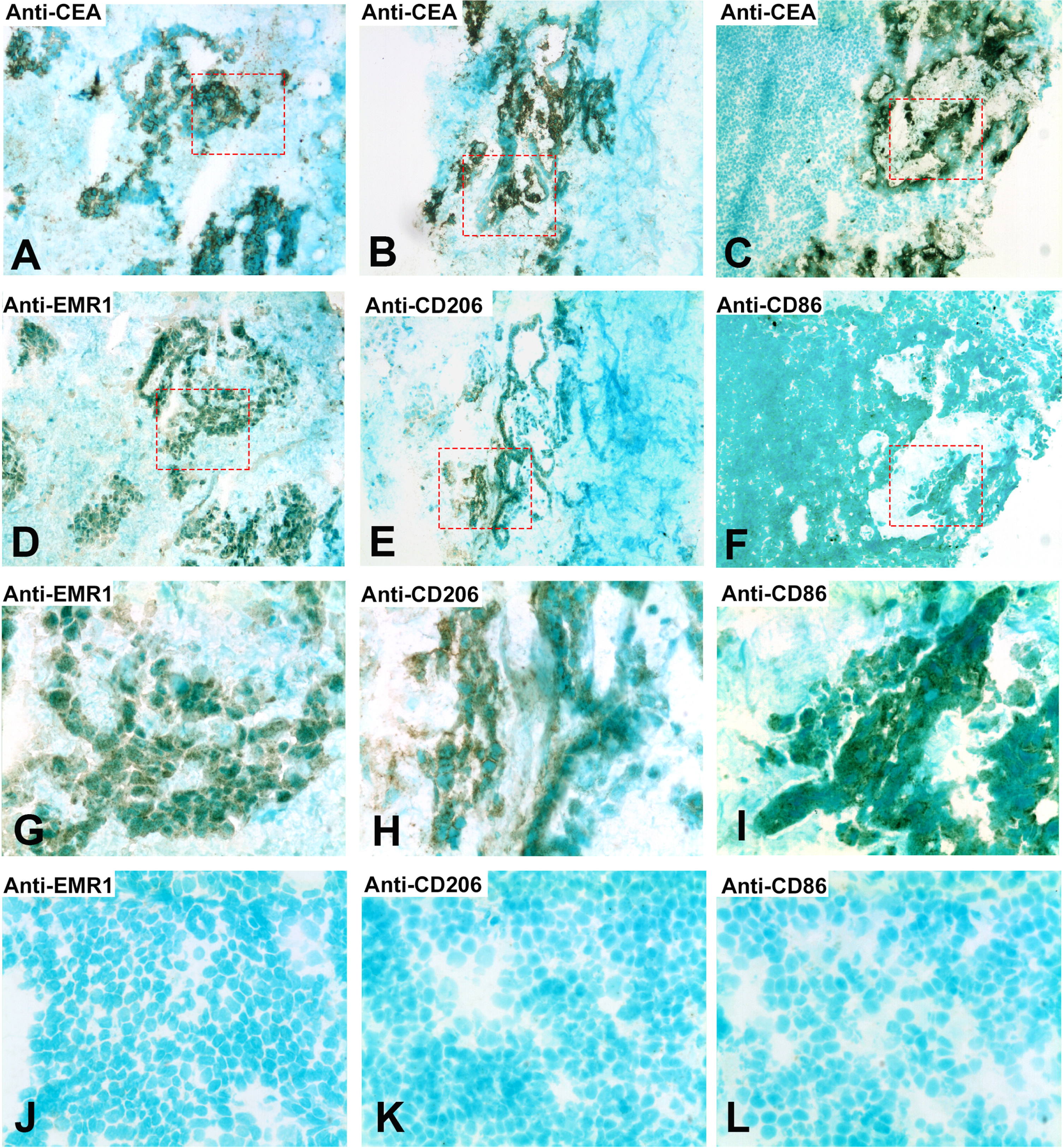Immunoperoxidase staining of tissue sections of a CC lymph node metastasis. (A), (B), (C) Anti-CEA staining of an H&E (+) lymph node from a CC patient, original magnification 100×. (D) Anti-EMR1 staining of a consecutive section of (A), original magnification 100×. (E) Anti-CD206 staining of a consecutive section of (B), original magnification 100×. (F) Anti-CD86 staining of a consecutive section of (C), original magnification 100×. (G) Higher magnification of indicated area in (D), 400×. (H) Higher magnification of indicated area in (E), 400×. (I) Higher magnification of indicated area in (F), 400×. (J) Anti-EMR1 staining of an H&E(–) lymph node of a CC patient, 400x. (K) Anti-CD206 staining of an H&E(–) lymph node of a CC patient, 400x. (L) Anti-CD86 staining of an H&E(–) lymph node of a CC patient, 400x. Positive cells stained brown to black. Methyl-green was used for counterstaining.