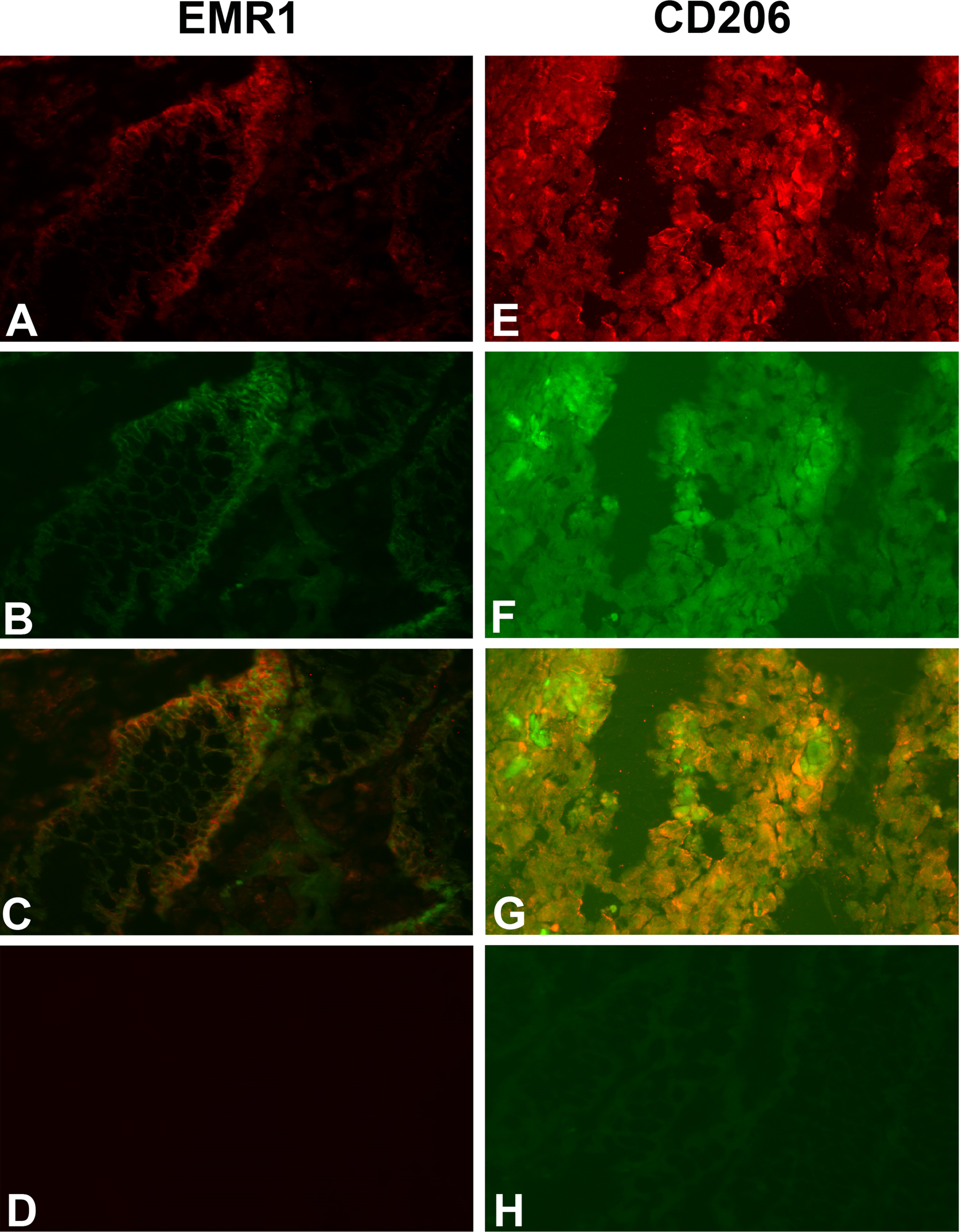Two-color immunofluorescence staining of primary CC tissue with anti-EMR1 and anti-EpCAM, and anti-CD206 and anti-EpCAM. (A) Anti-EMR1, (E) Anti-CD206, both red color. (B, F) anti-EpCAM, green color. (C, G) Overlays giving yellow color of double-stained cells. (D) Rabbit IgG; negative control for anti-EMR1 (H). FITC-conjugated mouse IgG; negative control for anti-EpCAM. Original magnification:×200.