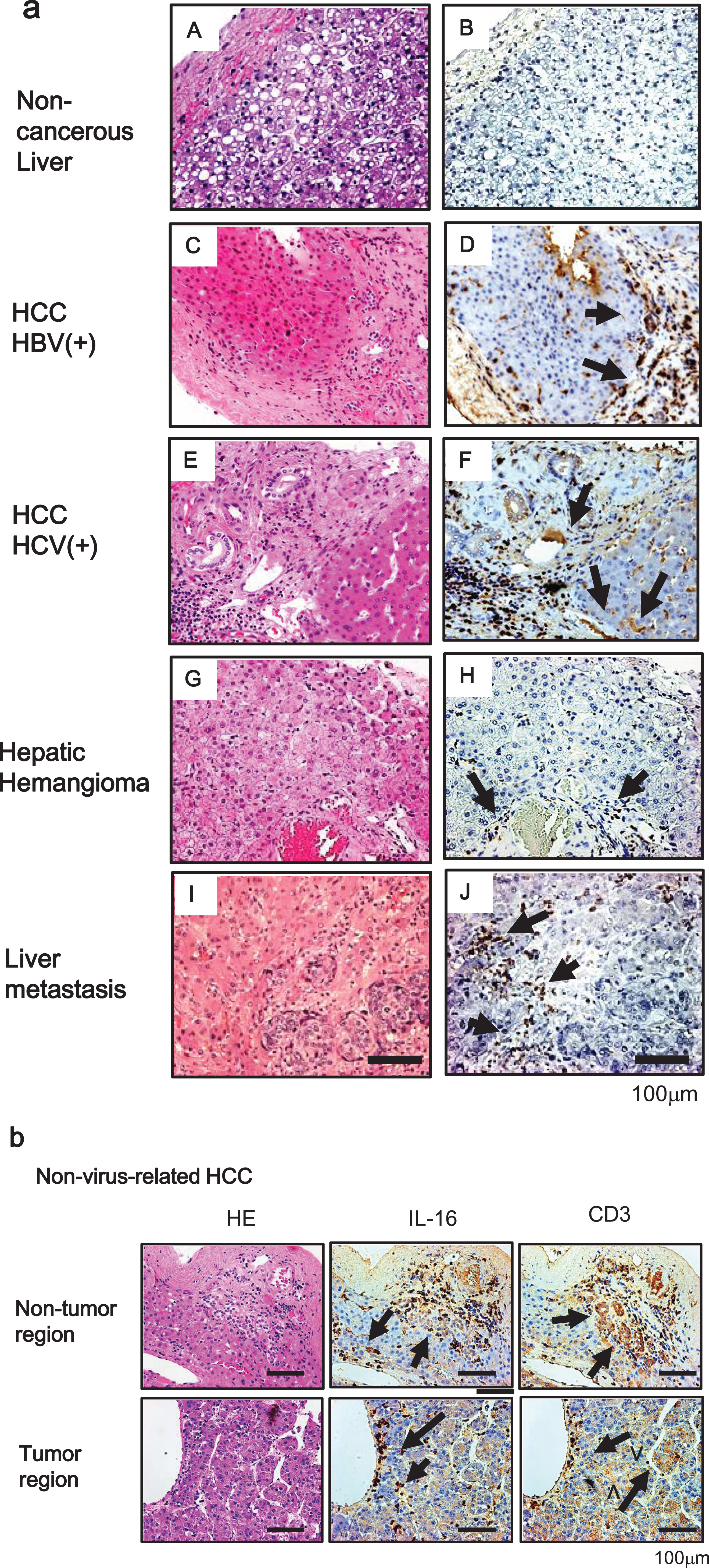 (a) Immunohistochemical analysis of IL-16 in tissue samples of noncancerous liver (B), hepatitis B virus-related HCC (D), hepatitis C virus-related HCC (F), hepatic hemangioma (H), and liver metastasis of colorectal cancer (J). Consecutive sections were stained with hematoxylin and eosin (A, C, E, G, and I). Original magnification×200. Scale bar = 100μm. (b) IL-16-positive cells around the infiltration area of CD3-positive cells from tumor (lower panel) and adjacent non-tumor regions (upper panel) of nonviral-related HCC. Consecutive sections stained with hematoxylin and eosin are shown on the right side. Original magnification×200. HBV+, hepatitis B virus-positive; HCV+, hepatitis C virus-positive. Scale bar = 100μm.