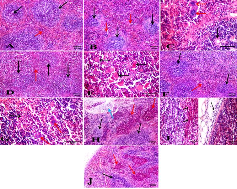 Photos of spleen sections stained with hematoxylin and eosin. (A) Normal healthy group showing average lymphoid follicle (white bulb) with central arteriole (black arrow) and average blood sinusoids (red bulb) (red arrow) (H&E X200). (B) DMBA-treated group showing atrophied lymphoid follicles (black arrows) with markedly expanded red bulb showing leukemic cells with large nuclei (red arrows) (H&E X200). (C) DMBA-treated group showing part of atrophied lymphoid follicles with central arteriole (black arrow) and markedly expanded red bulb with leukemic blast cells with large convoluted nuclei (red arrows) (H&E X400). (D) BFB -treated 1/10 group showing average lymphoid follicles (white bulb) (black arrows) with mildly expanded red bulb (red arrow) (H&E X200). (E) BFB -treated 1/10 group showing expanded red bulb with leukemic infiltrate showing most of blast cells with faint apoptotic nuclei (black arrows) (H&E X400). (F) BFB -treated 1/5 group showing average lymphoid follicles with central arterioles (black arrows) and mildly expanded red bulb (red arrow) (H&E X200). (G) BFB -treated 1/5 group showing expanded red bulb showing necrotic cells (black arrow) with scattered bi-nucleated and multi-nucleated giant cells (red arrows) (H&E X400). (H) BFB control 1/10 group showing average lymphoid follicles (black arrows) with mildly expanded red bulb showing areas of necrosis (red arrow), and extra-capsular inflammatory infiltrate (blue arrow) (H&E X200). (I) BFB control 1/5 group showing red bulb with areas of necrosis (black arrows) and extra capsular inflammatory infiltrate (red arrow) (H&E X400). (J) BFB control 1/5 group showing atrophied lymphoid follicles (black arrow) with markedly expanded red bulb showing areas of necrosis (red arrows) (H&E X 200).