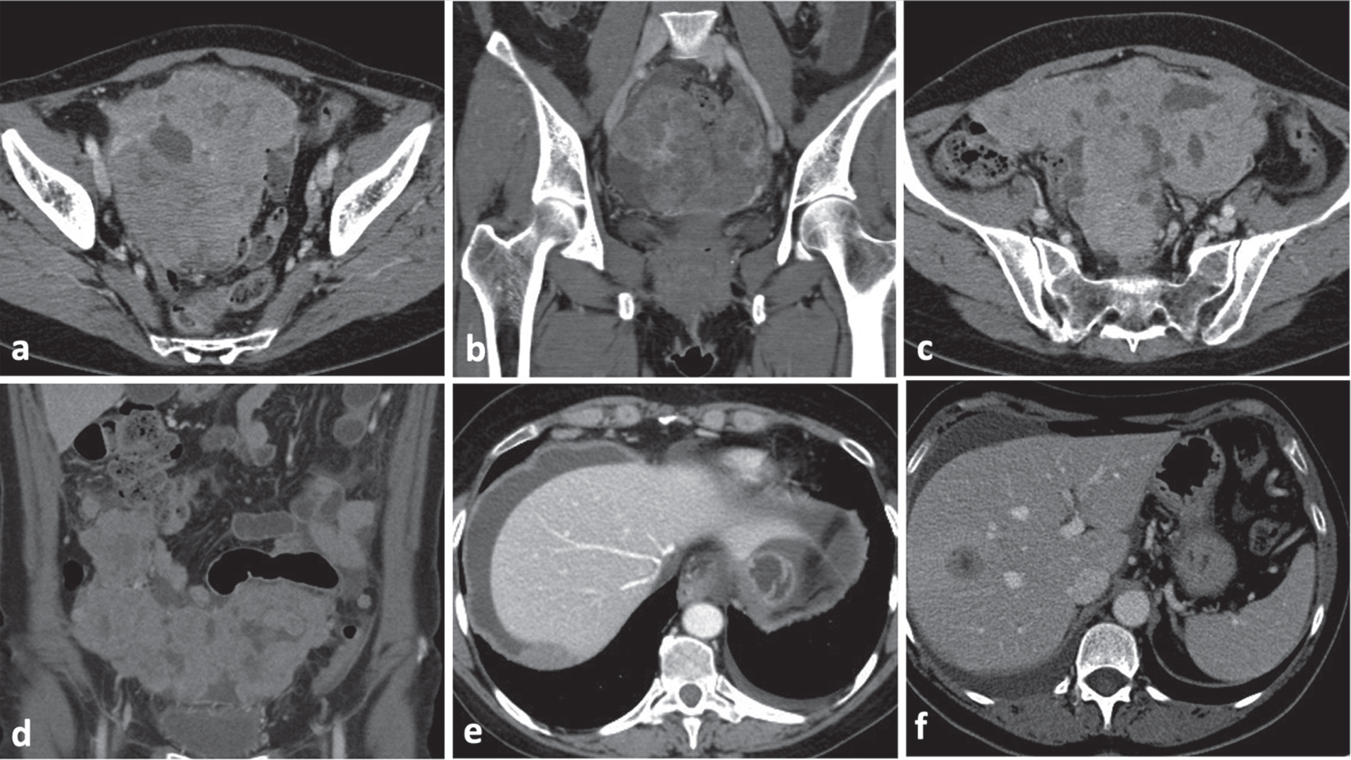 BRCA-mutated OC typical features consist in: bilateral ovarian masses with a solid/predominantly solid structures (Fig. 2a-b); macronodular carcinomatosis with predominant nodular morphologic pattern characterized by well-defined/ rounded /“pushing” borders; PD composed of macronodular implants which confluence each other in a plaque-like thickenings of omental fat assuming the so called “omental cake” aspect (Fig. 2c-d); presence of pericardiophrenic lymphadenopathy (short-axis greater than 0.5 cm) (Fig. 2e); presence of liver metastasis (Fig. 2f).