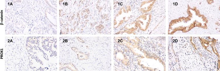The immunohistochemical staining pattern of β-catenin and PROX1 in neoadjuvant treated pancreatic ductal adenocarcinoma. The staining pattern of β-catenin using monoclonal beta Catenin antibody (CAT-5H10) (1A-1D) and PROX1 using Human PROX1 Antibody (2A-2D) in neoadjuvant treated pancreatic ductal adenocarcinoma. Representative images of β-catenin expression (1A) negative cytoplasmic expression with weak membranous positivity, (1B) weak cytoplasmic positivity, (1C) moderate cytoplasmic positivity, and (1D) strong cytoplasmic positivity. Representative images of PROX1 expression (2A) negative expression, (2B) weak cytoplasmic positivity, (2C) moderate cytoplasmic positivity, and (2D) strong cytoplasmic positivity. Magnification 200x is used in all separate images. The corresponding scale bar can be seen in lower right corner.