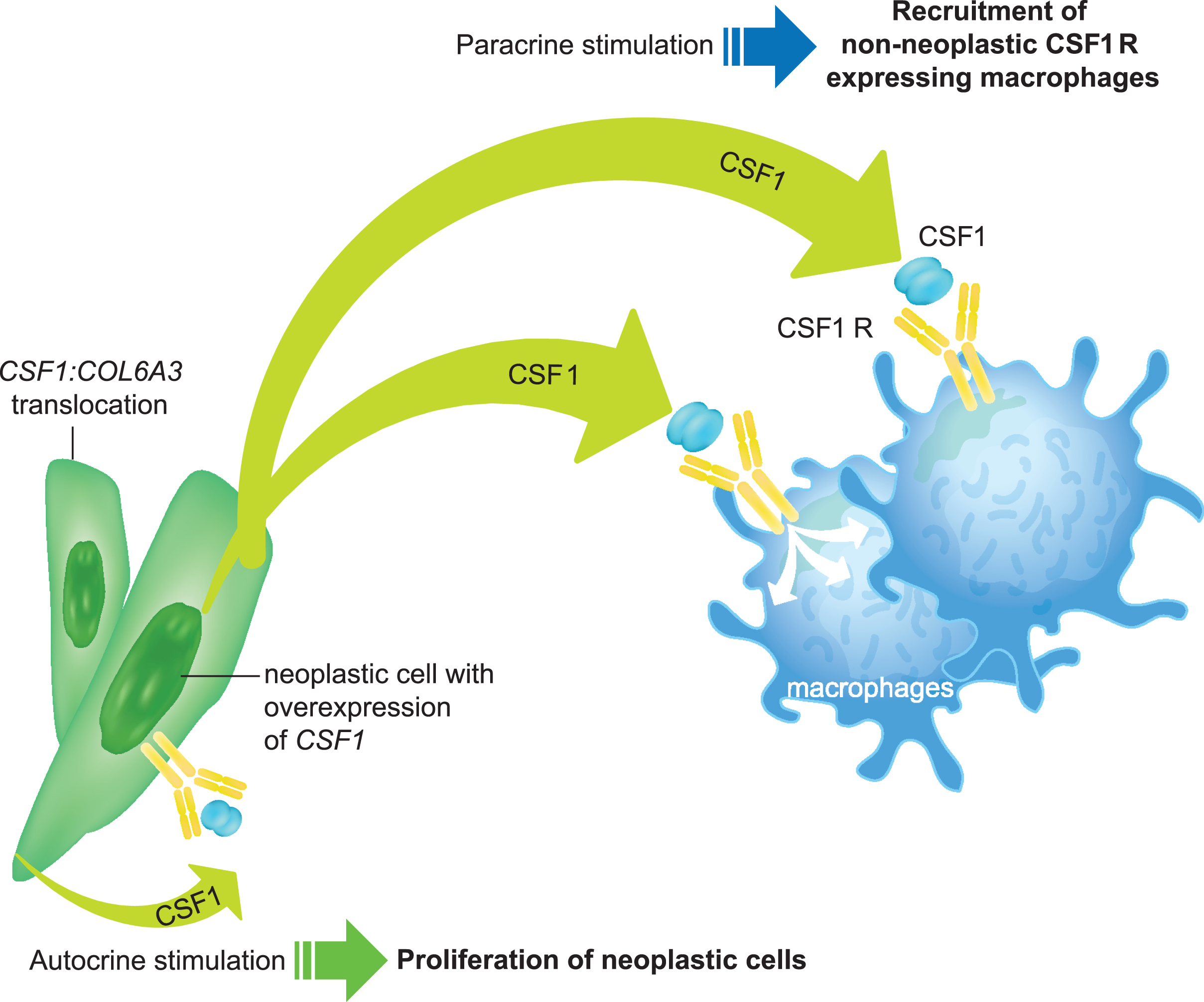 Role of the CSF1/CSF1R axis in the development of TGCT. Overexpression of CSF1R (e.g., through CSF1:COL6A3 gene translocation) promotes cell proliferation and accumulation in the synovium, while binding of the CSF1 ligand to the CSF1R leads to activation of signaling pathways that modulate differentiation, proliferation, and chemotaxis toward the source of CSF1, leading to the recruitment of inflammatory cells to the joint cavity.CSF1, colony-stimulating factor 1; CSF1R, colony-stimulating factor 1 receptor; TGCT, tenosynovial giant cell tumor.