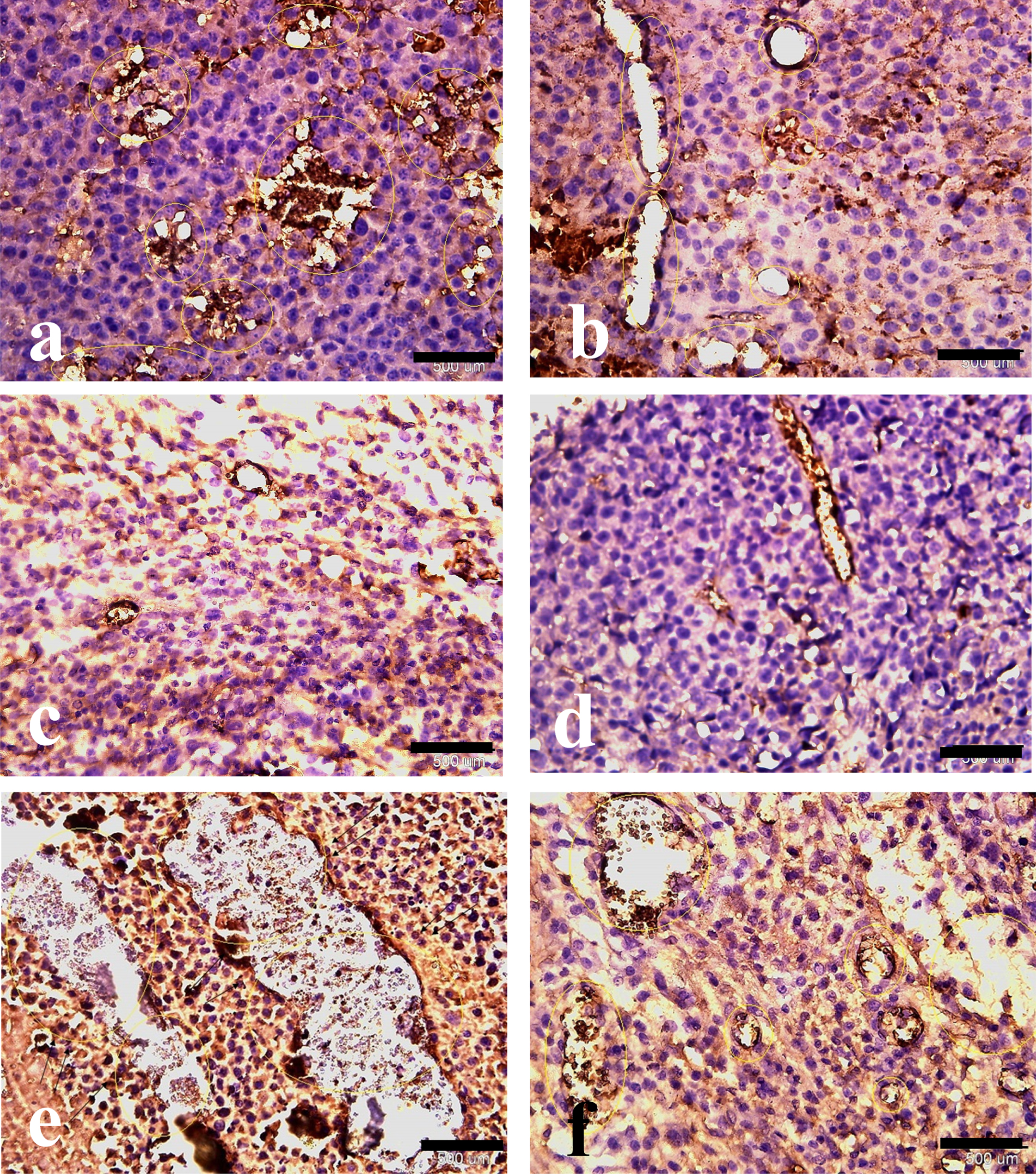 Hematoxylin and eosin with anti-CD31 immunohistochemical staining of melanoma tumor tissue. Effect of HIF-1α and ALK5 signaling pathways on tumor vessel density in a mouse melanoma model between the control and treatment groups (40x magnification). Picture A represents CD31 staining in the control group. Pictures B, C, D, E, and F represent CD31 staining in HIF-ihb, HIF-ihb/Alk5-ihb, Alk5-ihb, HIF-act, and HIF-act/Alk5-ihb groups respectively. Alk5-ihb: ALK5 inhibitor, HIF-ihb: HIF-1α inhibitor, HIF-act: HIF-1α activator. Scale bar is 500 um.