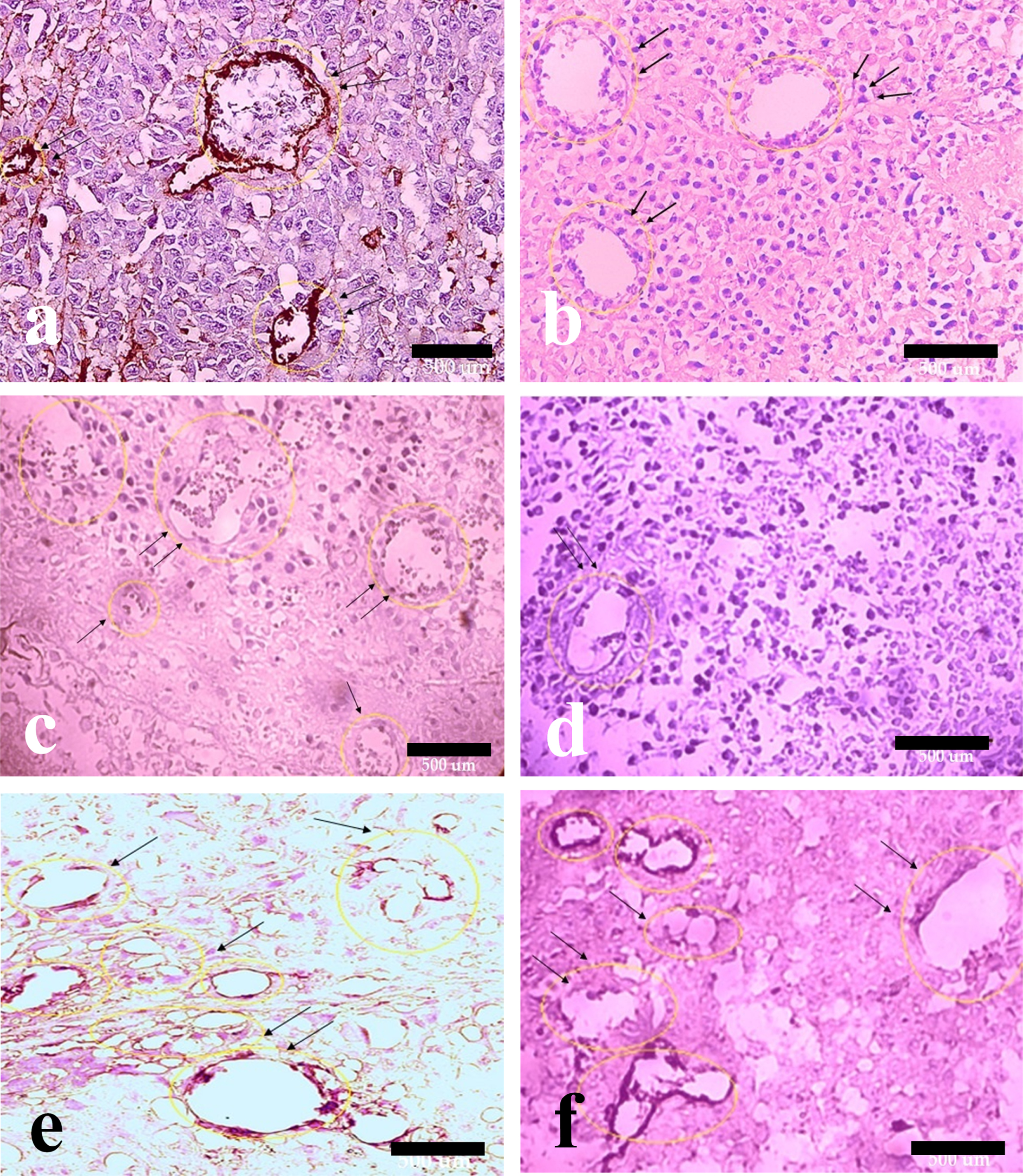 Hematoxylin and eosin with anti-PDGFR immunohistochemical staining of melanoma tumor tissue. Effect of HIF-1α and ALK5 signaling pathways on pericyte recruitment in a mouse melanoma model between the control and treatment groups (40x magnification). Picture A represents PDGFR staining in the control group. Pictures B, C, D, E, and F represent PDGFR staining in HIF-ihb, HIF-ihb/Alk5-ihb, Alk5-ihb, HIF-act, and HIF-act/ Alk5-ihb groups, respectively. Alk5-ihb: ALK5 inhibitor, HIF-ihb: HIF-1α inhibitor, HIF-act: HIF-1α activator. Scale bar is 500 µm.