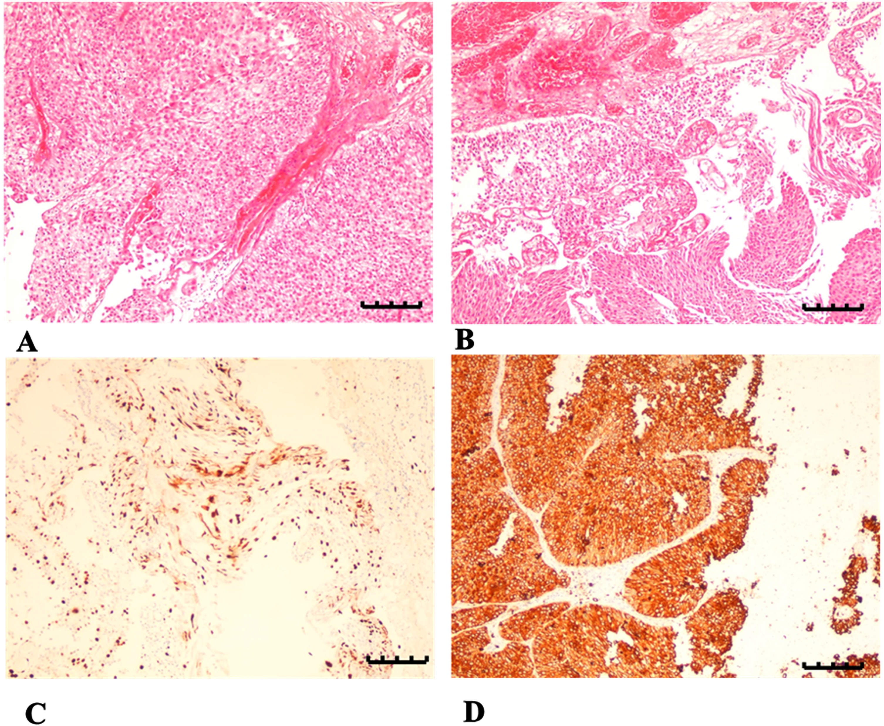 Microscopic histopathology provides images of cross sections of BC obtained from both Group 2 and Group 3 and analyzed under light microscopy, magnitude 100μm. H&E stain was added to A and B samples demonstrating imbalance in bladder cells, showing atypical sizes and forms for normal cells. Section A was obtained from Group 2; section B was obtained from Group 3, both demonstrating occasional textures of bladder tissues showing abnormal mitotic signs, decreased nucleoli, necrosis effects, presence of intracellular/extracellular elements and elevated level of RBCs with several overfilled veins. Sections C and D demonstrated immunity to stains by releasing PAF-R antibody. Section C was obtained from Group 2 demonstrating weak yet positive staining of PAF-R protein in non-smoking male participants with BC; meanwhile, Section D was obtained from Group 3 demonstrating strong and positive staining of PAF-R protein in male smokers with BC.