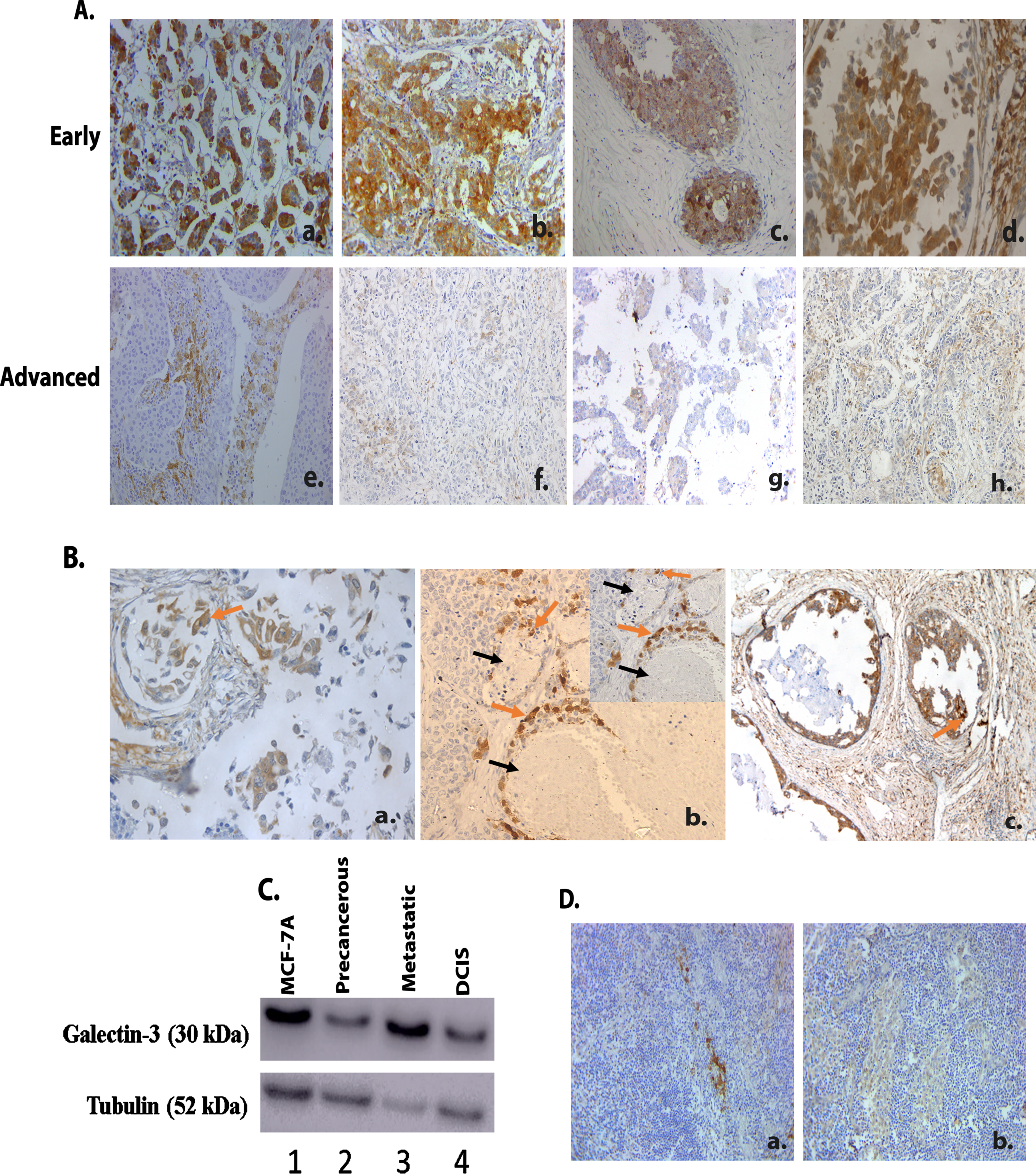 Galectin-3 expression in human breast tumor tissues A. 489 IDC samples were immunohistochemically stained using a monoclonal galectin-3 antibody as described in Materials and methods. A. Representative images of breast tumor tissues showing galectin-3 expression in early (Stage 1A-StageIIIA) (a- (20X), b-(20X), c-(20X) & d-(20X) and advanced stages (Stage IIIB- Stage IV) (e-(20X), f-(20X), g-(20X), h-(20X) of primary breast tumors in TNBC. B. (a.) Representative image of primary tumor tissue showing galectin-3 expression in invading areas (20X). Arrow (orange) indicates invading tumor cells. (b.) Representative image of primary tumor tissue showing galectin-3 expression in tumor cells near blood vessels (20X). Arrow (black) indicates blood vessel and Arrow (orange) indicates tumor cells near blood vessels. (c.) Representative image of primary tumor tissue showing galectin-3 expression in intraductal areas (20X). Arrow (orange) indicates tumor cells in the intraductal area. C. Western blot analysis of galectin-3 expression in breast cancer cell line model for tumor progression (1-MCF 10A (Normal), 2- MCF 10 AT (Precancerous), 3- MCF 10CA1D (Metastatic), 4- MCF 10DCIS (DCIS). Tubulin was used as the loading control. D. Both a. (20X) and b. (20X) show representative images of IHC analysis of galectin-3 expression in metastatic lymph node tissues from TNBC patients. The tumors were categorized into galectin-3 low (overall H-score<150) and galectin-3 high (overall H-score>150). H-scores were calculated by multiplying intensity score (0 = negative, 1+ = light, 2+ = moderate, 3+ = intense, 4+ = heavy) with the percentage of stained tumor cells. Overall score less than 40 was considered negative.