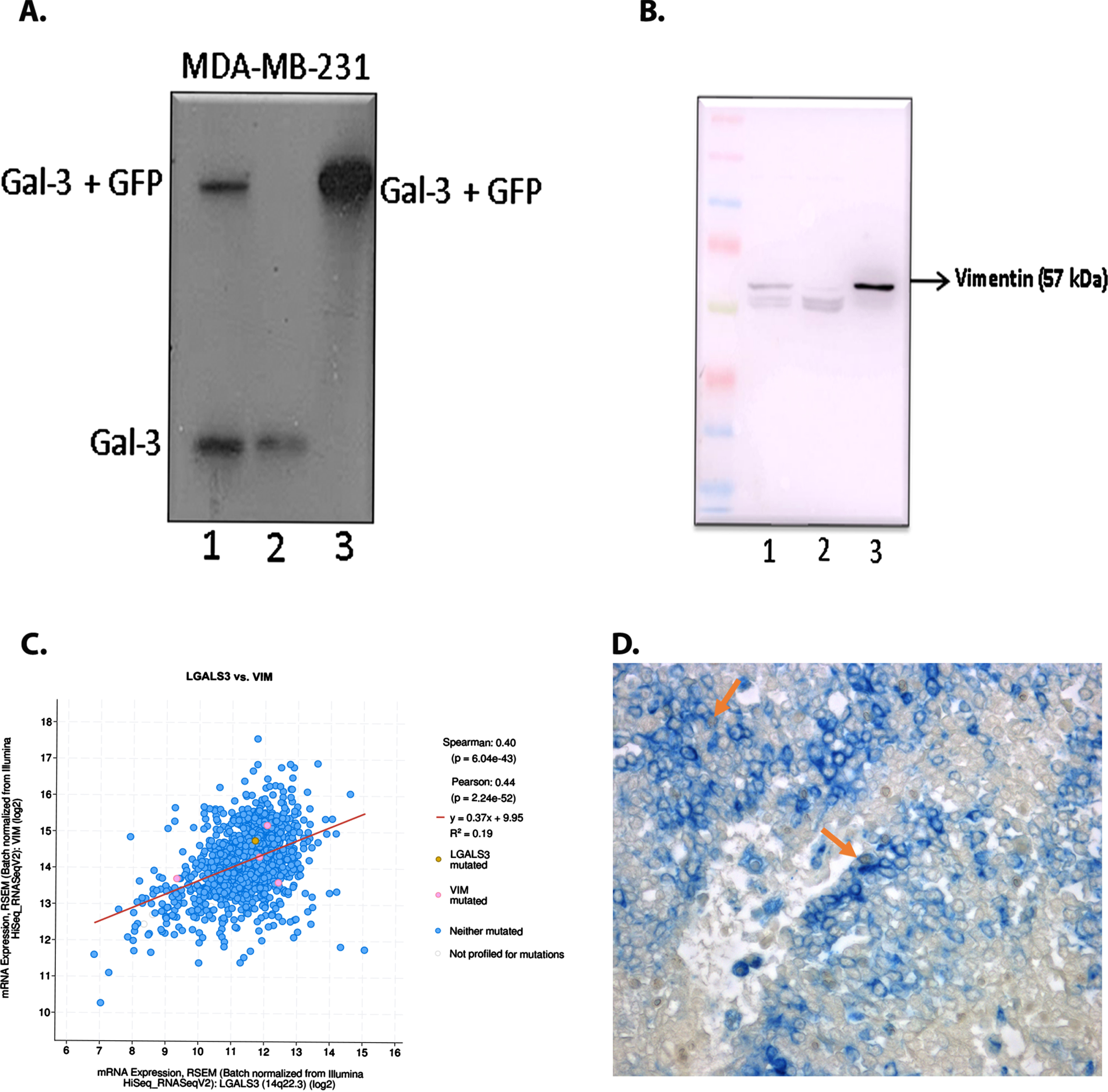 Identification of galectin-3-interacting proteins A. Overexpressed galectin-3 fraction with GFP after pull down assay using GFP-TRAP was confirmed using western blotting [1-Input (Protein sample from Galectin-3-GFP overexpressed MDA-MB-231 cells), 2- Unbound (Supernatant of protein sample after incubation with GFP-trap beads), 3- Bound (Galectin-3-GFP protein bound to the GFP-TRAP beads)]. B. Pull down sample subjected to immunoblotting analysis was found to have vimentin protein substantiating the association of vimentin with galectin-3 (1-Input, 2- Unbound, 3- Bound). C. Co-expression analysis of galectin-3 and vimentin done using m-RNA data from TCGA database in cBioPortal. D. Representative image of breast tissue sample showing dual staining of galectin-3 and vimentin in tumor cells (Magnification: 20X). Arrow indicates tumor cells co-expressing both galectin-3 (brown) in the cytoplasm and vimentin (blue) in the membrane.