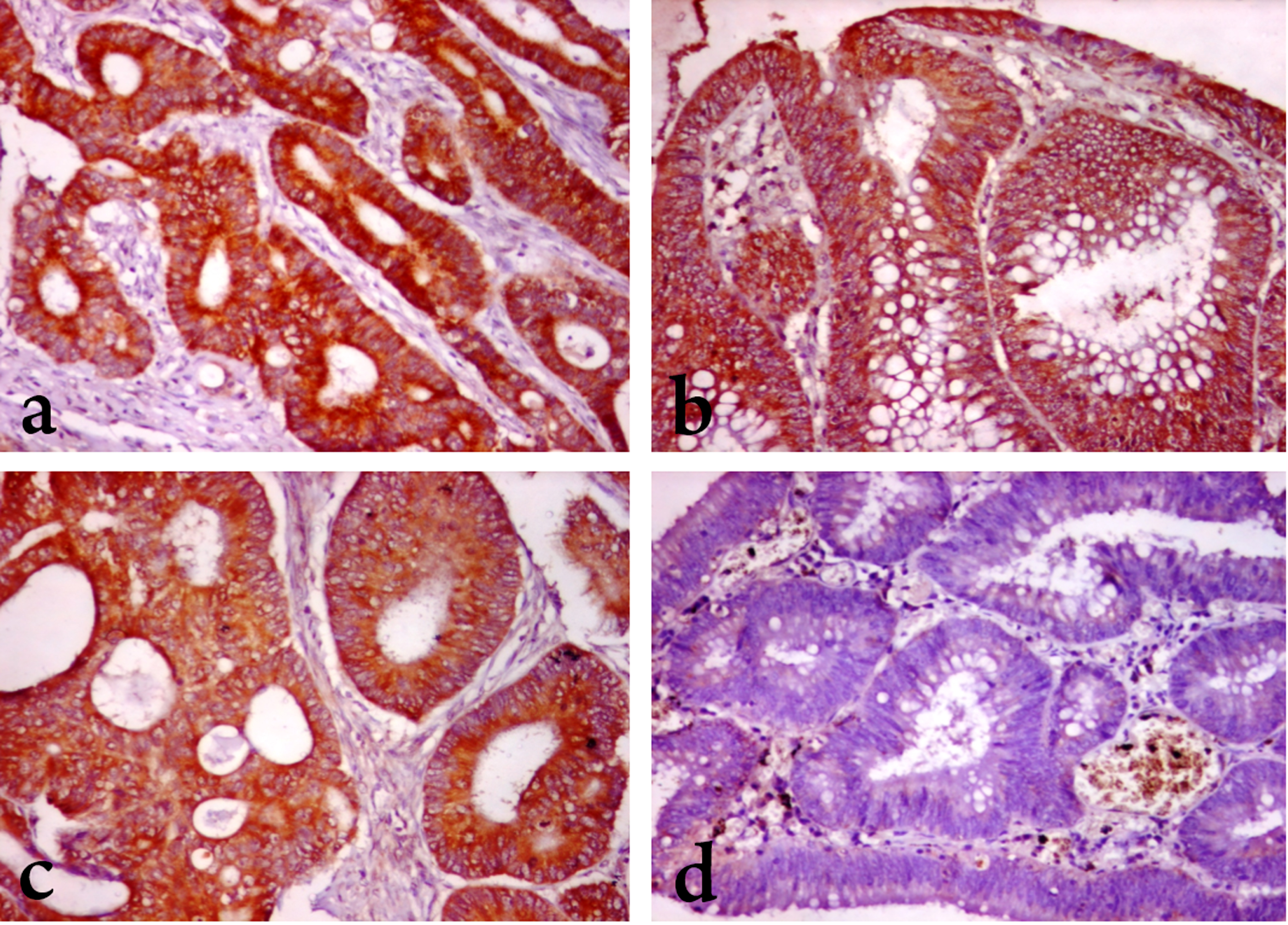 MEK1 and DIAPH3 expression in colorectal carcinoma and adenoma. (A) Marked MEK1 cytoplasmic staining in a case of grade II CRC (B) Moderate MEK1 cytoplasmic staining in moderately dysplastic epithelium of adenoma. (C) Moderate DIAPH3 cytoplasmic staining in in a case of grade II CRC. (D) Negative DIAPH3 staining in moderately dysplastic adenoma. (x 200).