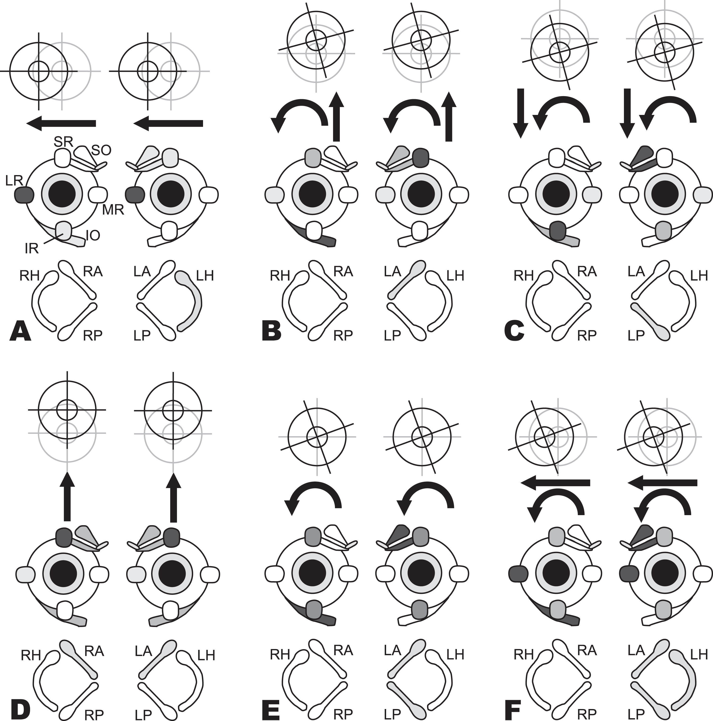 Nystagmus slow phases observed for excitation of individual semicircular canals. In the bottom row of each panel (A through F), shading indicates the excited canals. In the second row, a diagram of the extraocular muscles depicts which muscles are activated (darker shading indicates stronger activation). In the top row, the resultant yaw, pitch, and/or roll eye movements are indicated. (A) Excitation of the left horizontal (LH) canal causes rightward slow phases mainly as a result of strong activation of right lateral rectus (LR) and left medial rectus (MR). (B) Excitation of the left anterior (LA) canal causes upward/clockwise (from patient’s perspective) slow phase because of the combined action of the right inferior oblique (IO) and superior rectus (SR) and the left superior oblique (SO) and SR. (C) Excitation of the left posterior (LP) canal causes downward/clockwise (from patient’s perspective) slow phases as a result of the combined action of the right IO and inferior rectus (IR) and the left SO and IR. (D) Combined equal excitation of both the left anterior (LA) and right anterior (RA) canals activates bilateral SR and oblique muscles and causes purely upward slow phases since the torsional components from each canal cancel each other. (E) Combined equal excitation of left anterior (LA) and left posterior (LP) canals excites muscle activity that is the sum of each canal’s individual effect; upward and downward pulls cancel, which results in a purely torsional nystagmus. (F) Combined equal excitation of all three left canals causes a right-clockwise (from patient’s perspective) slow phase, the expected result of summing activity for each individual canal. (Modified from Cohen et al [37]; adapted from Cummings Otolaryngology: Head and Neck Surgery. Flint, Haughey (eds.). Sixth edition [61]. Chapter 163: Principles of applied vestibular physiology. Carey JP, Della Santina CC. ISBN: 978-1-4557-4696-5. Data adjusted to human head frame of reference.)
