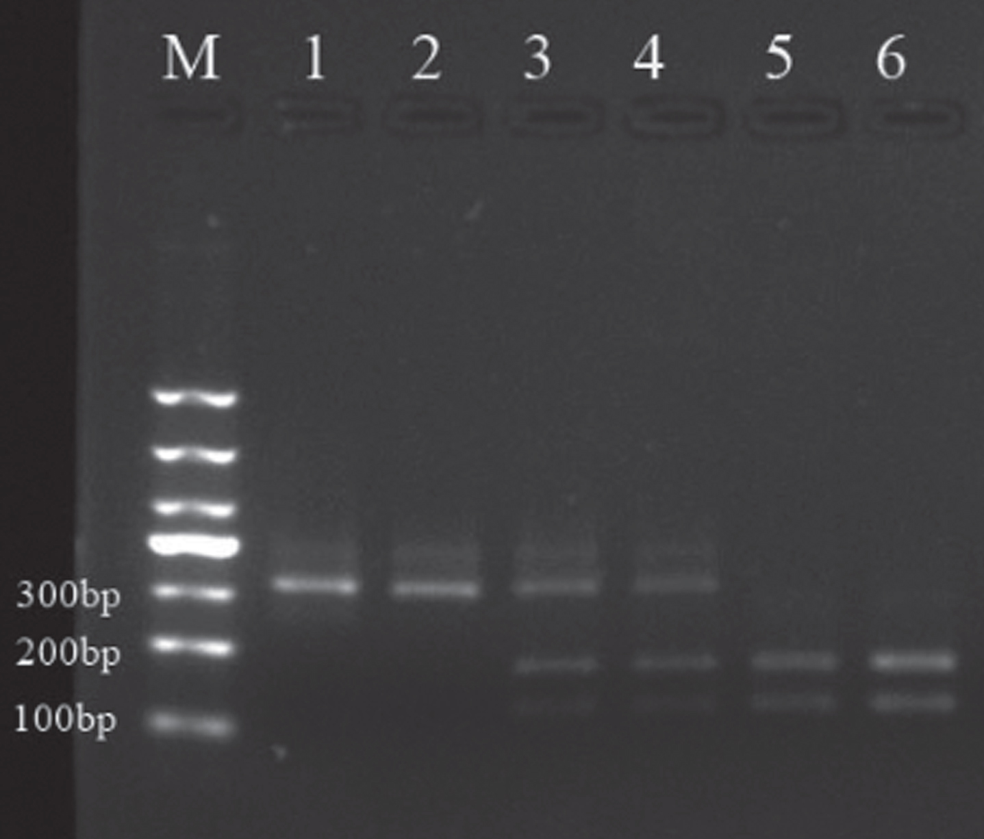 Sampling electrophoresis figure. M is the Marker, 1, 4and 5 are respectively A1/A1, A1/A2 and A2/A2 gene type in patients group; 2, 3 and 6 are respectively A1/A1, A1/A2, A2/A2 gene type in the control group.