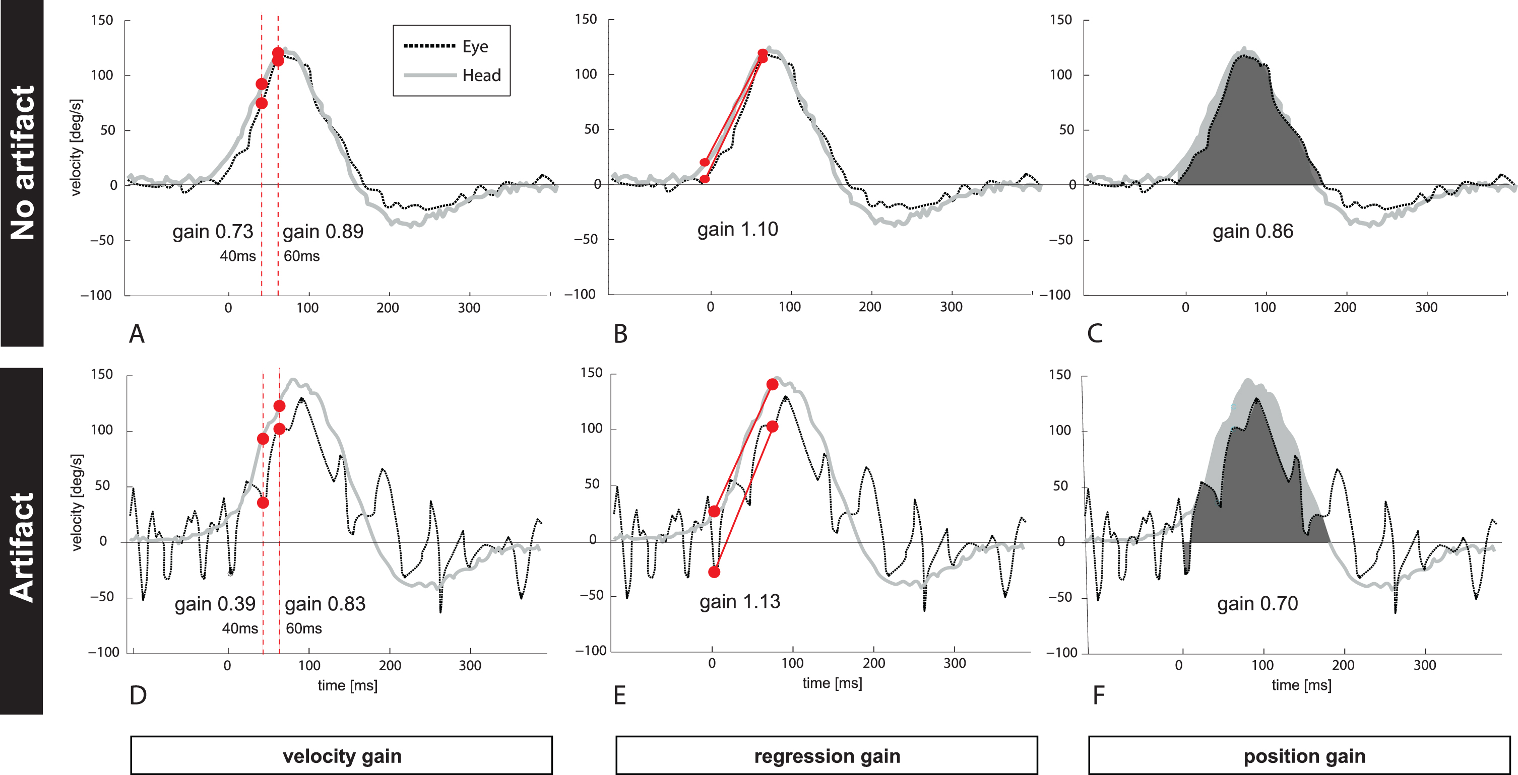 
Figure 1 depicts one clean (Fig. 1A–C, no artifacts) and unclean (Fig. 1D–E, trace with artifacts) vHIT example (eye- and head velocity profile) from one patient with PICA stroke. The unclean vHIT shows trace oscillation artifacts due to intermittent pupil tracking loss. VOR gain has been calculated by (A and D) taking different time points at 40 ms and at 60 ms after HIT onset (‘velocity gain’), (B and E) applying a linear regression (‘regression gain’), or (C and F) comparing the area under the curve for eye (black) and head (grey) velocity (‘position gain’). Note that VOR gain from the same patient and the same vHIT trace resulted in different VOR gains for each calculation method ranging from 0.73–1.1 (traces with no artifact) and from 0.39–1.13 if artifacts changed the morphology of the bell-shaped slow phase curve.