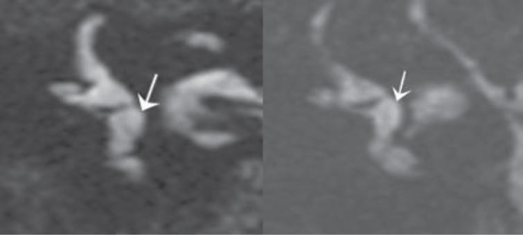 A)MRI, Coronal 3D gradient-echo T2-weighted sequence, showing an enlarged saccule (arrow), with increased height and width. The medial wall of the vestibule appears as a thin black line. B)Similar finding in another patient.