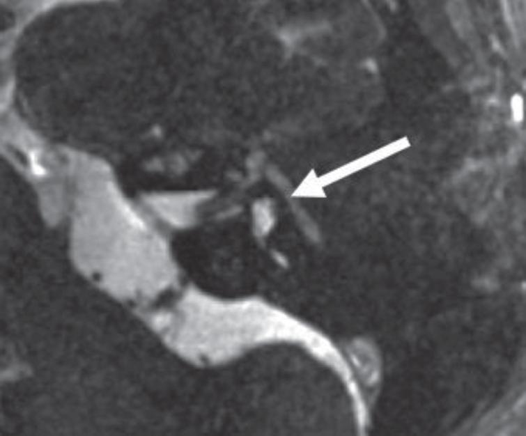 MRI, axial 3D gradient-echo T2-weighted sequence, showing a hyperintense facial nerve (arrow) in acute facial neuritis in a patient with acute left peripheral facial nerve palsy.