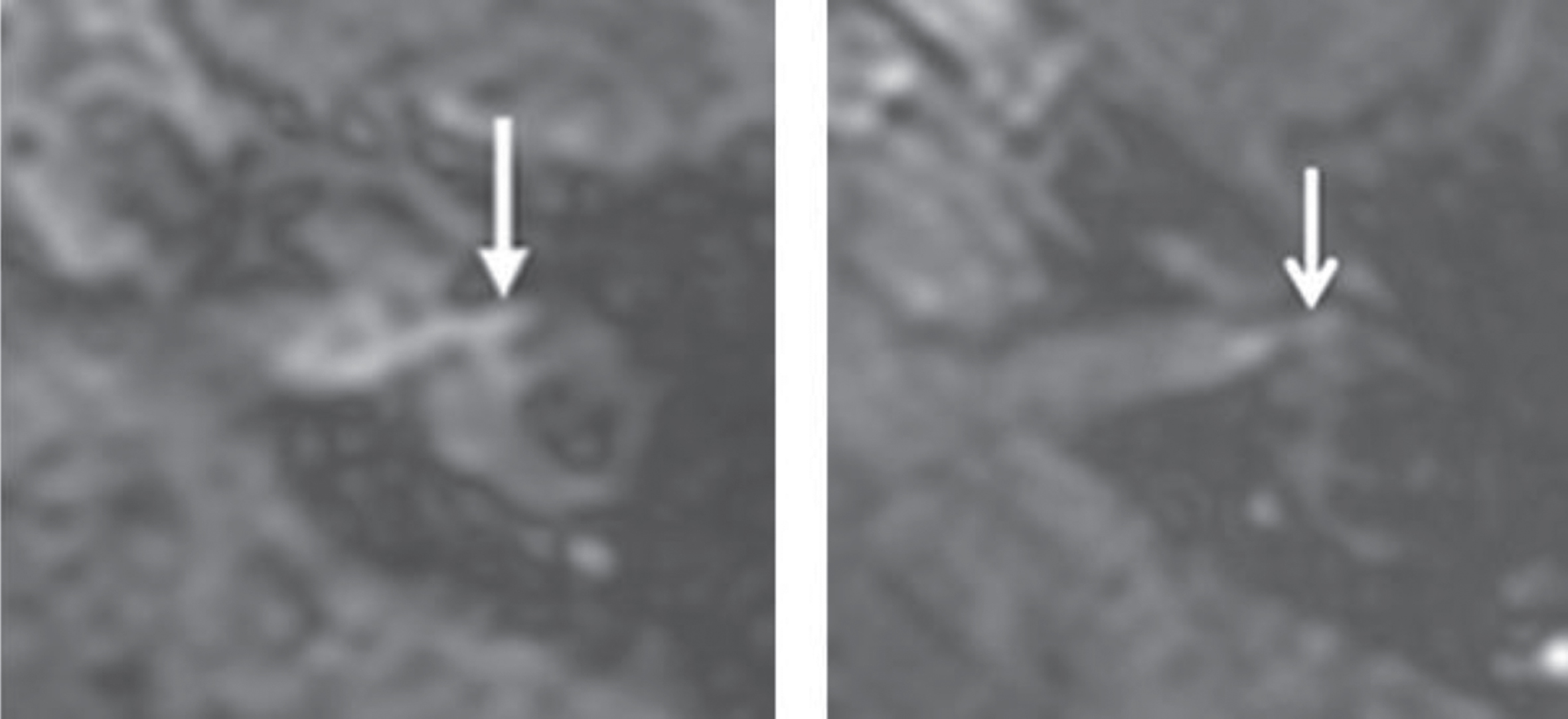 A)Axial contrast-enhanced (∼1h) FLAIR sequence showing an enhancing superior vestibular nerve (> 71.5 units, arrow) in a patient with an acute vestibular neuritis. B) Normal enhancement of the superior vestibular nerve (arrow) in another patient.