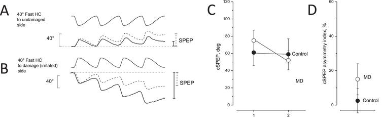 Eye movement recording during asymmetric rotation in response to opposite directed asymmetric rotation and asymmetric index in unaffected and MD patients. A, B: Slow phase eye position (SPEP) in response to opposite directed sequence of four cycles of asymmetric rotation with a fast half cycle toward the lesion side (A) and the healthy side (B). Upper traces: asymmetric rotation; and lower traces: SPEP (solid line: MD patients, dashed line: controls). Cumulative eye position at the end of rotation is indicated by vertical bars on the right (solid line: MD patients; dashed line: controls). Note that the cumulative SPEP of MD patients was smaller in A and greater in B compared with the controls. C: Cumulative SPEP (cSPEP) (mean and SD) of unaffected (control, filled circle) and MD patients (open circles) in response to opposite directed asymmetric rotation: fast half cycle to healthy or irritated side (left) versus fast half cycle to lesion or side not irritated (right). Note that controls did not show a different cumulative SPEP in contrast to MD patients. D: cSPEP asymmetry index in unaffected (control, filled circle) and in MD patients (open circles) in response to the opposite directed asymmetric rotation.
